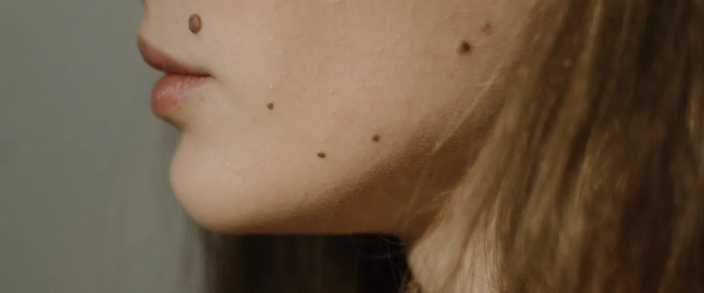 redessiner les contours du visage et la mâchoire grâce à l'acide hyaluronique au CEMF Lyon Vienne