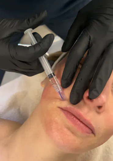 Mésothérapie vs Microneedling : clarifions les choses.