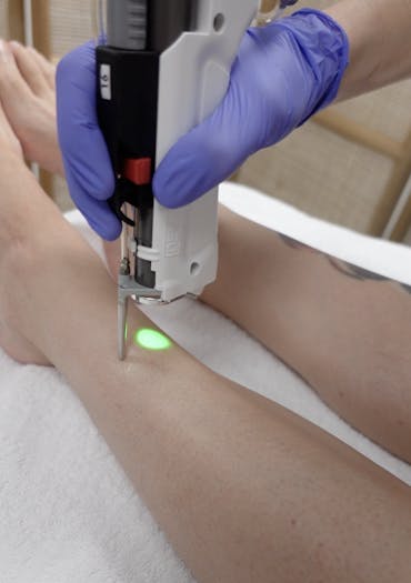 Professionnelle qui réalise une séance d'épilation laser sur les jambes d'une femme.
