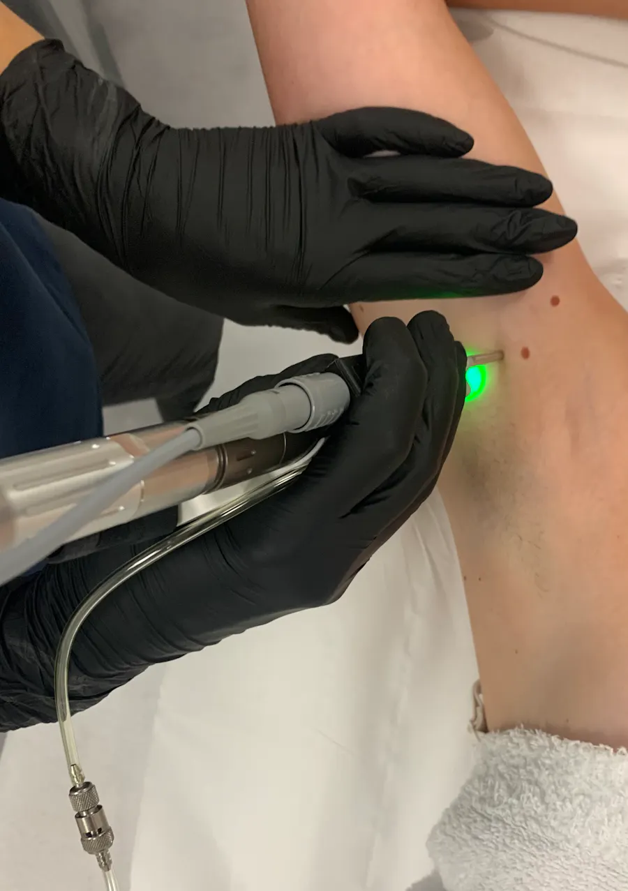 épilation laser et épilation par électrolyse