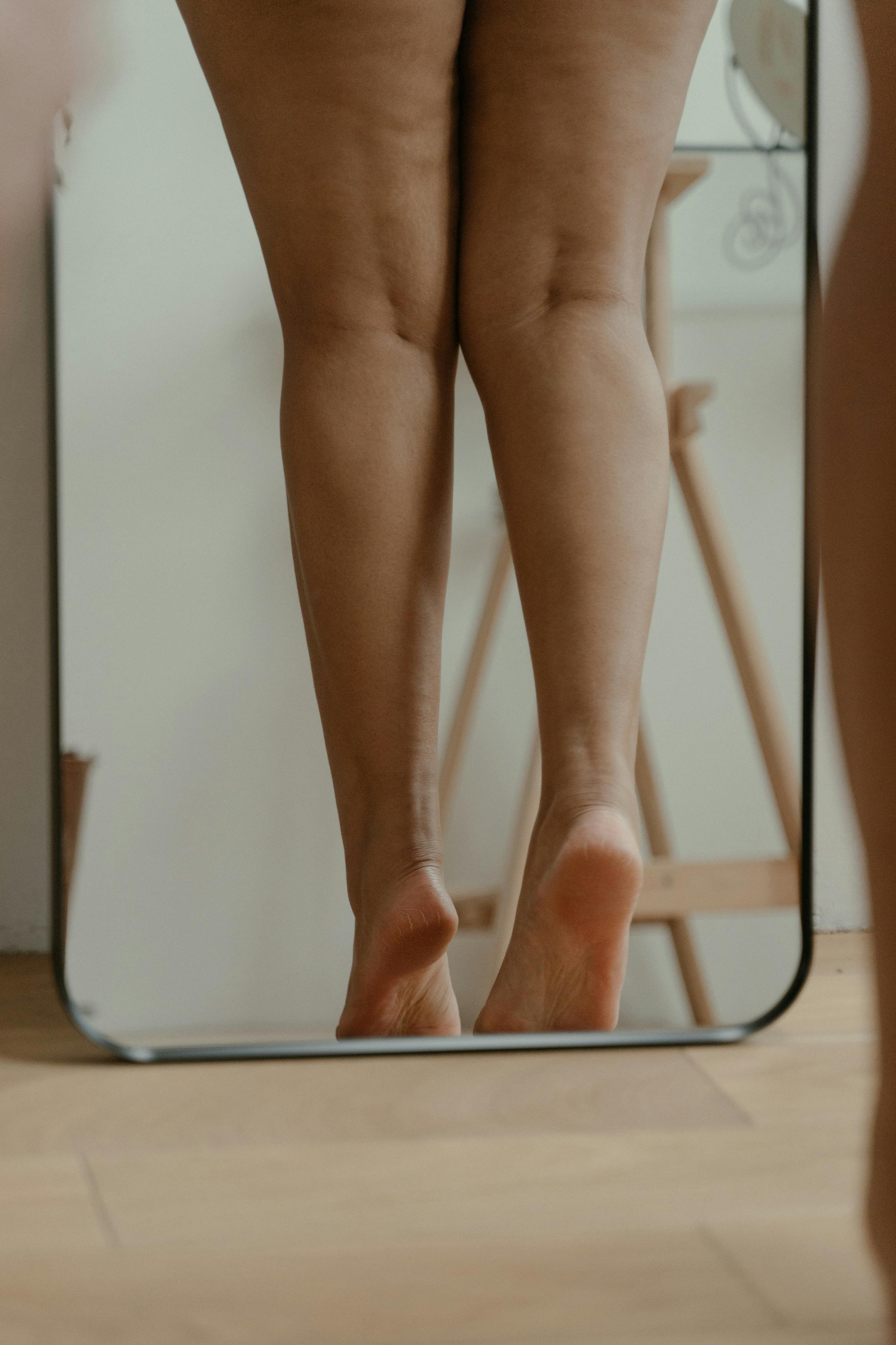 cellulite sur les jambes de femme 