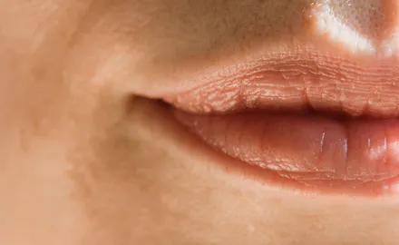 Acide hyaluronique dans les lèvres : quels sont les effets ?