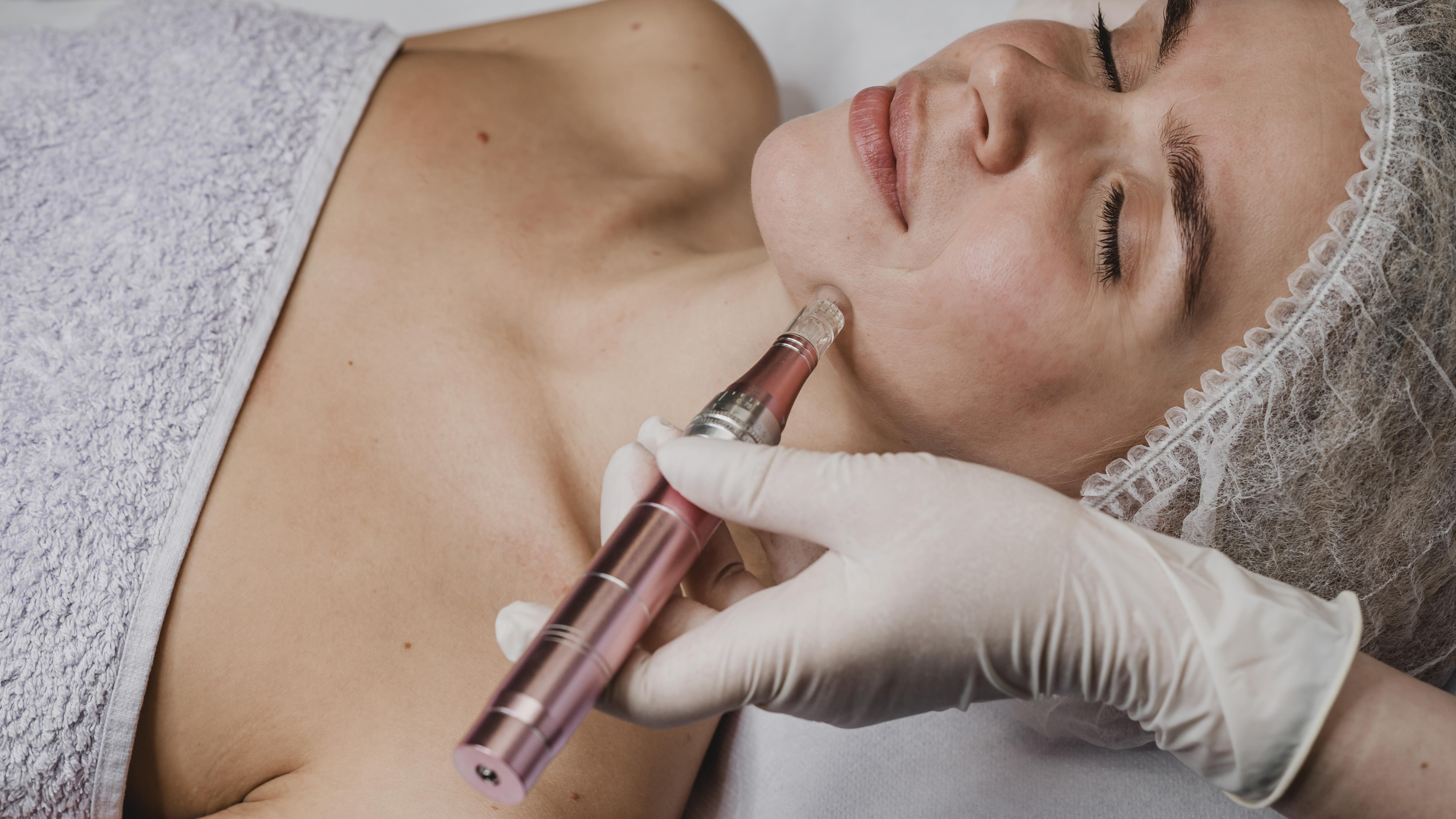 microneedling pour le traitement des cernes