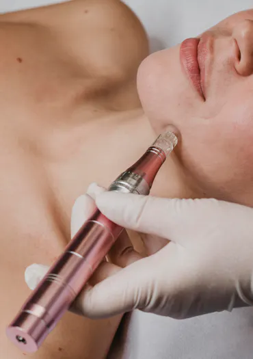 microneedling pour le traitement des cernes