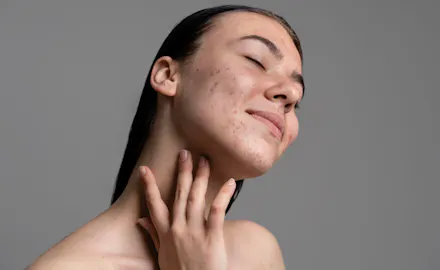 comment enlever les cicatrices d'acné | CEMF Lyon Vienne