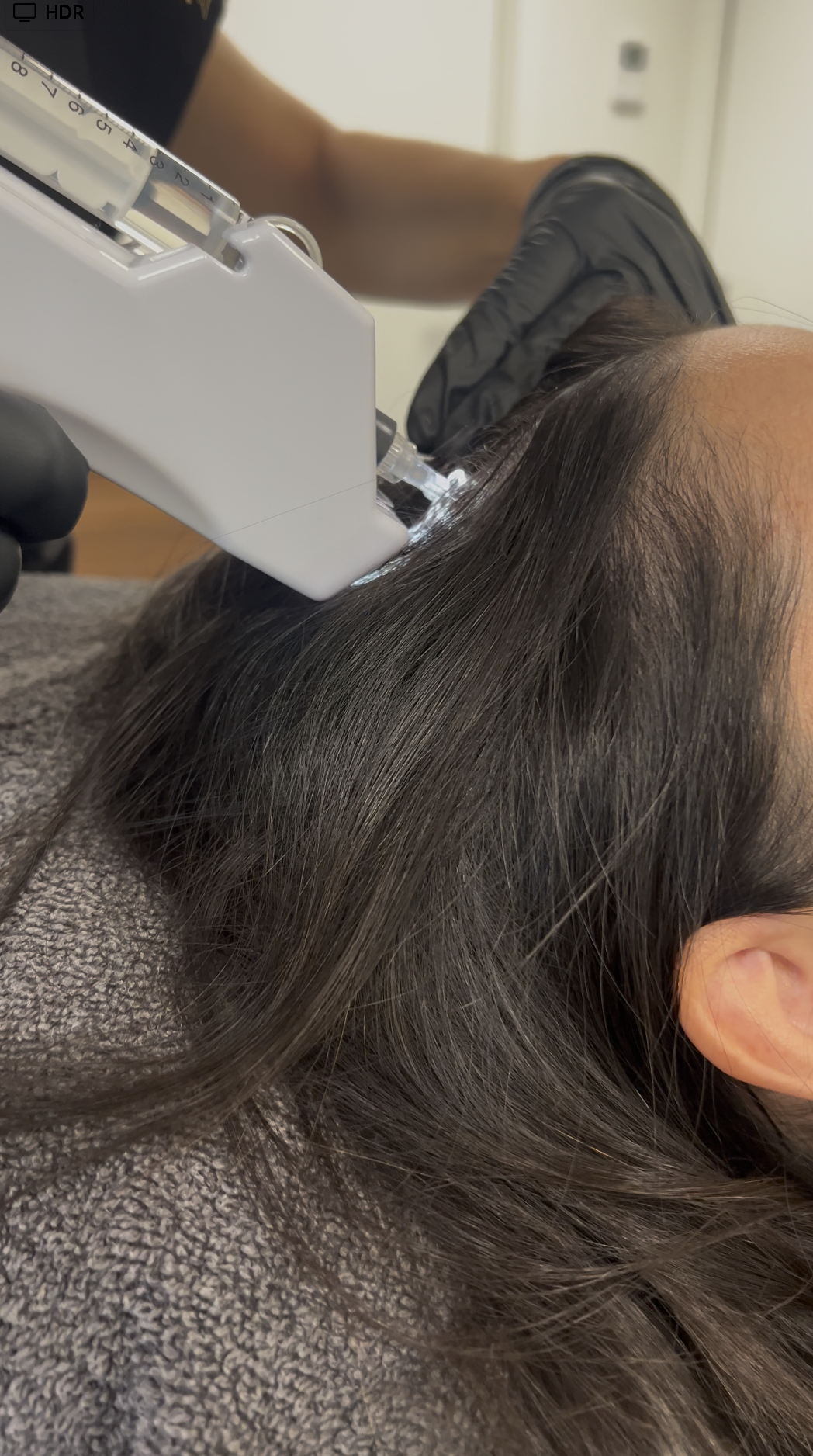 Séance de mésothérapie capillaire au CEMF Lyon Vienne par des experts