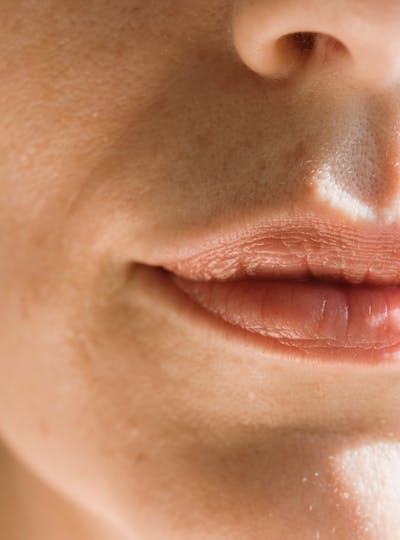 Embellir le sourire et redessiner et repulper les lèvres grâce aux injections d'acide hyaluronique au centre de médecine esthétique et laser Lyon Vienne