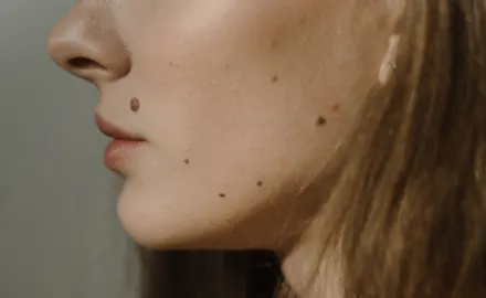 Taches brunes sur la peau