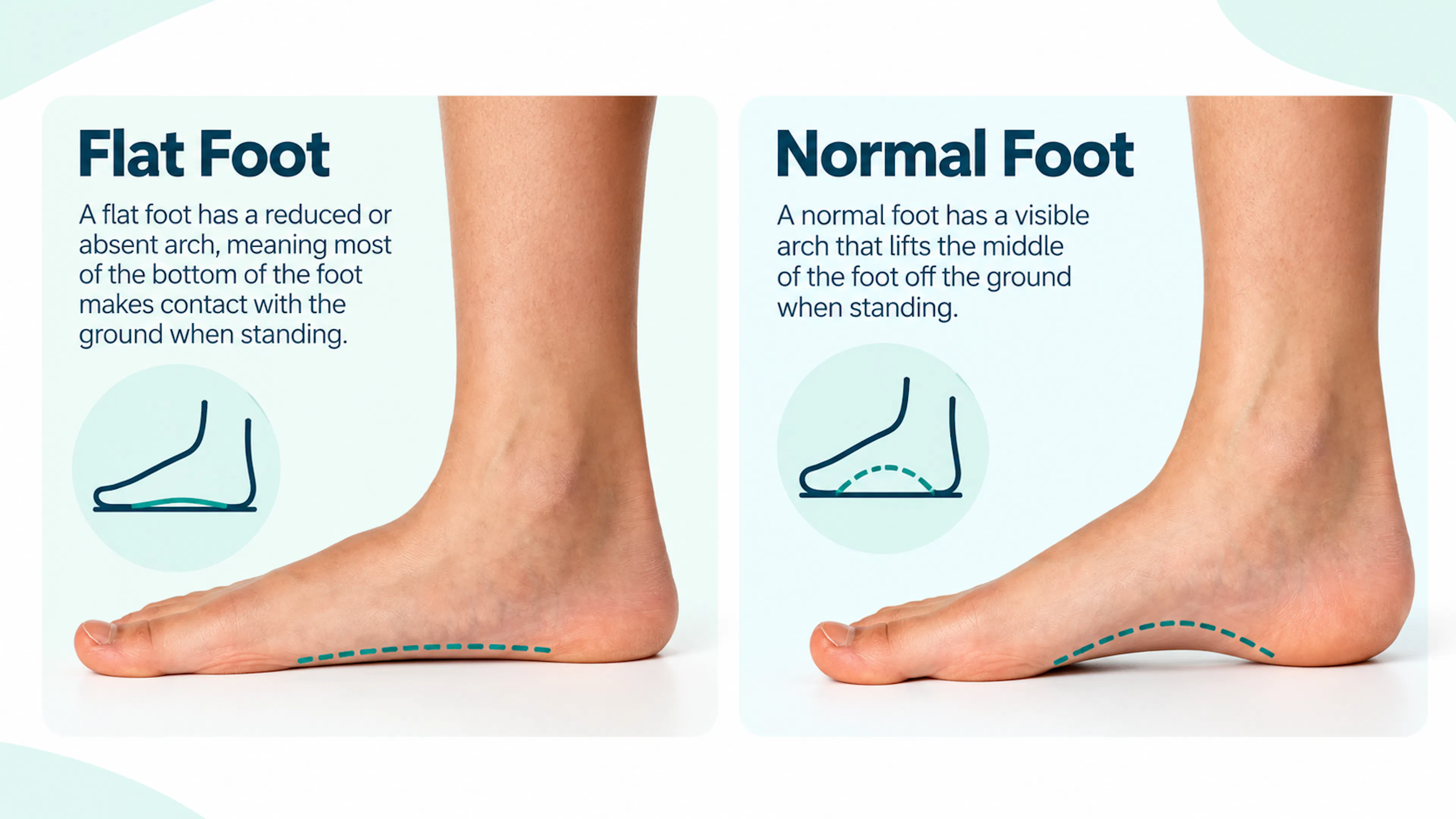 Flat Foot vs. Normal Foot Diagram | CLS Health