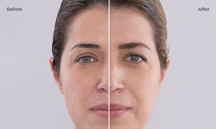 Before and after photos of a patient who received Sculptra, a facial filler.