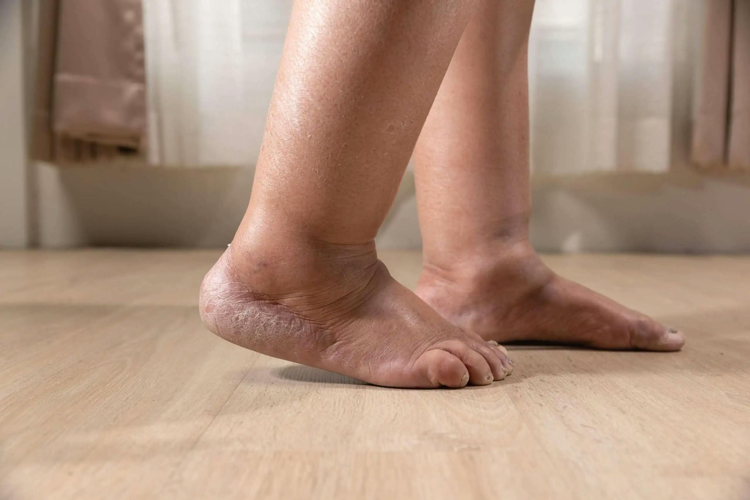 Close-up of swollen feet and ankles.