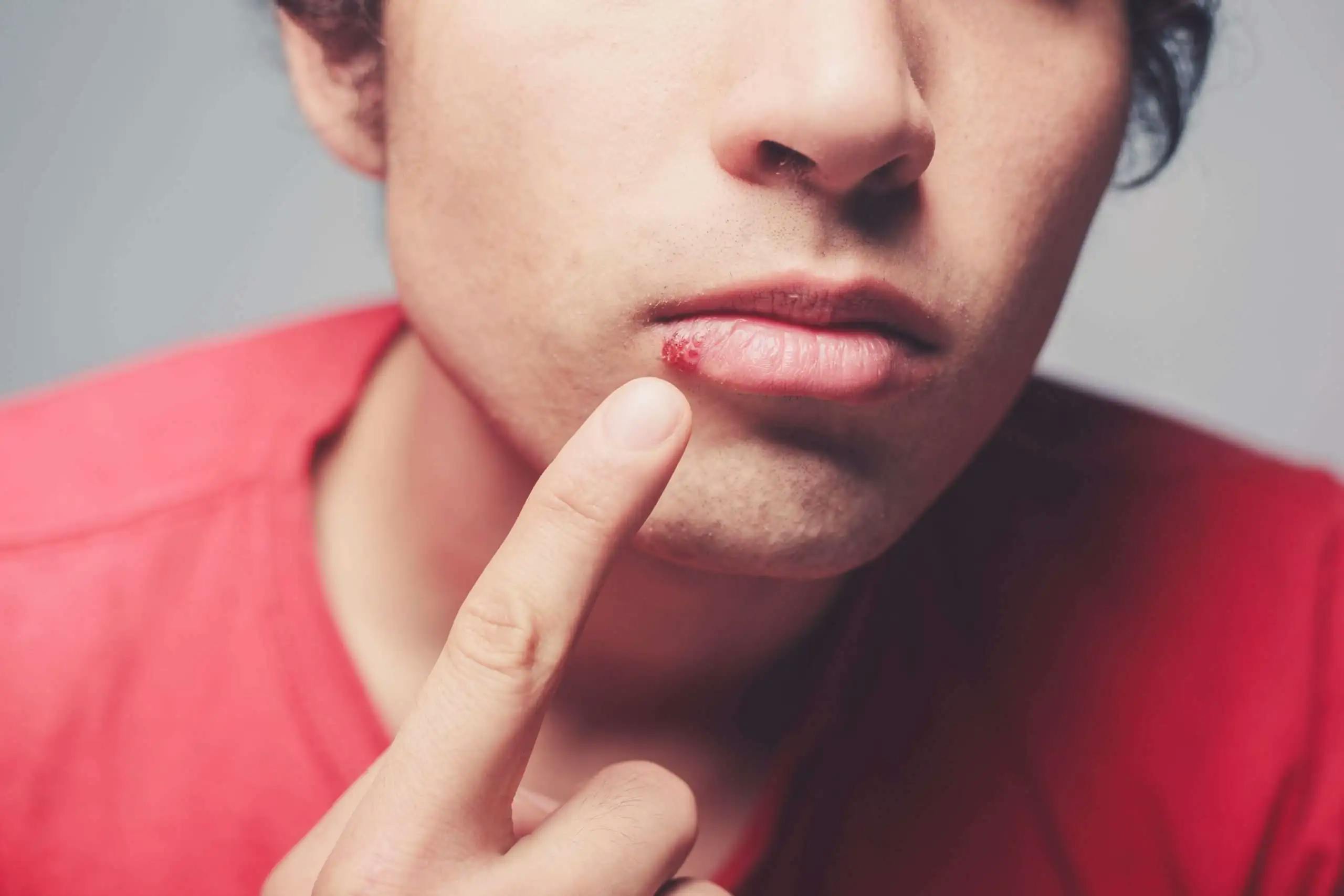 Close-up of cold sores on the lip, highlighting symptoms and treatment options for managing herpes simplex virus outbreaks.