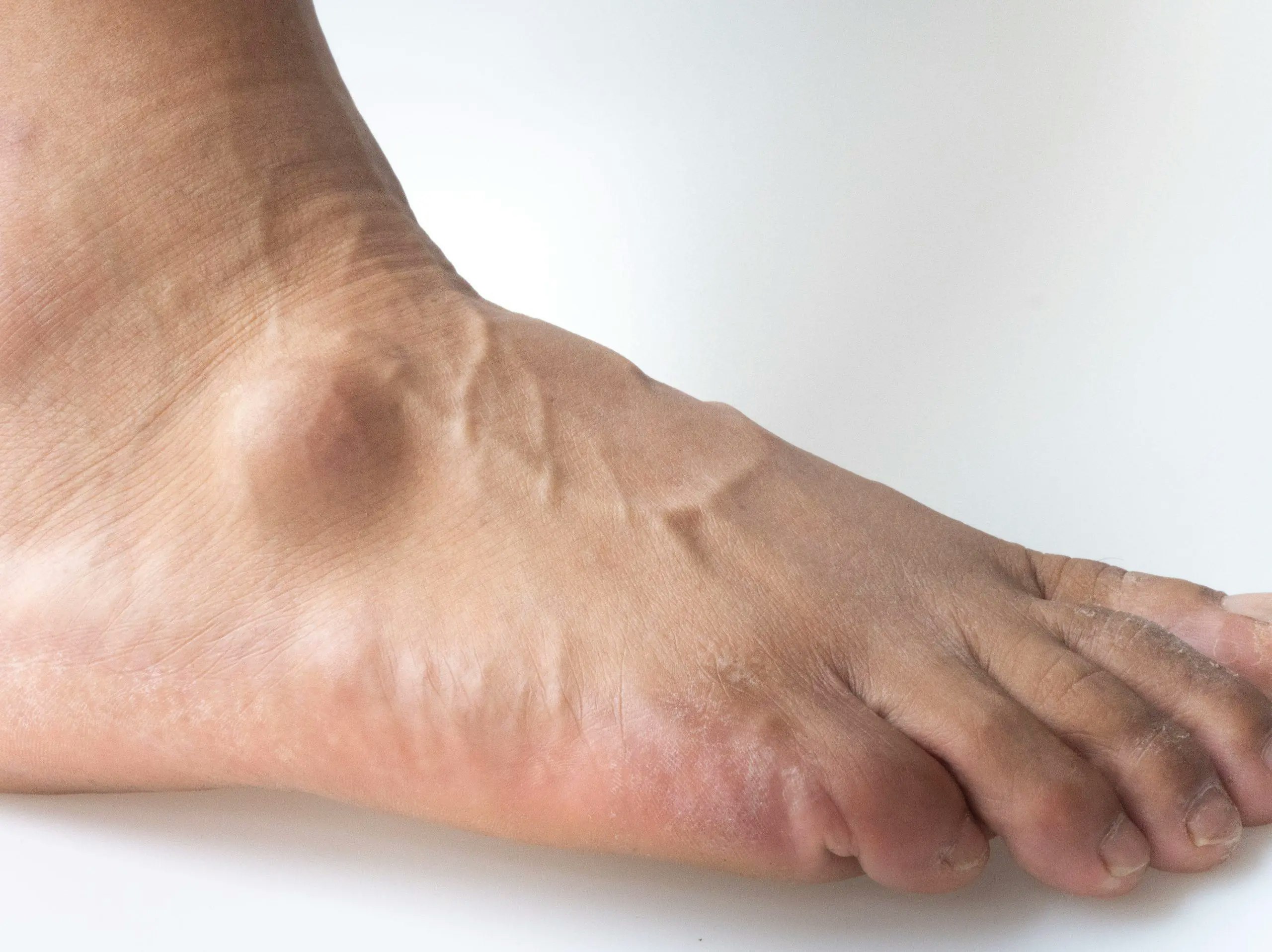 Close-up of foot and ankle cysts, showcasing common types such as ganglion cysts and treatment options for relief and management.