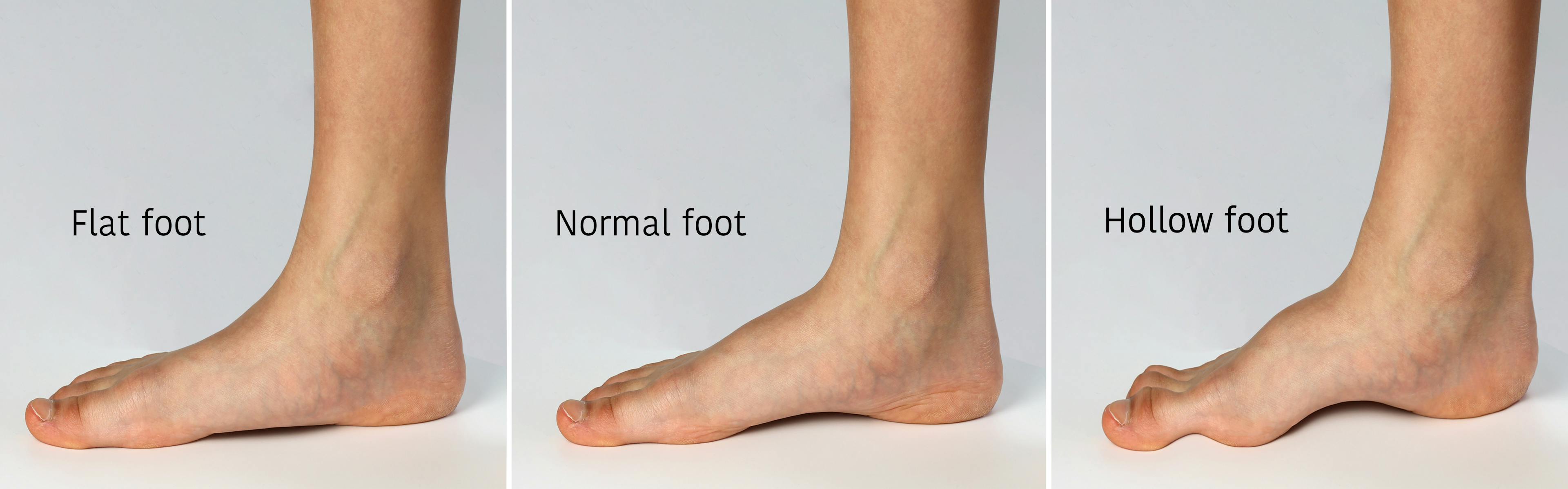 Close-ups of a Flat foot, Normal Foot, and Hollow foot.