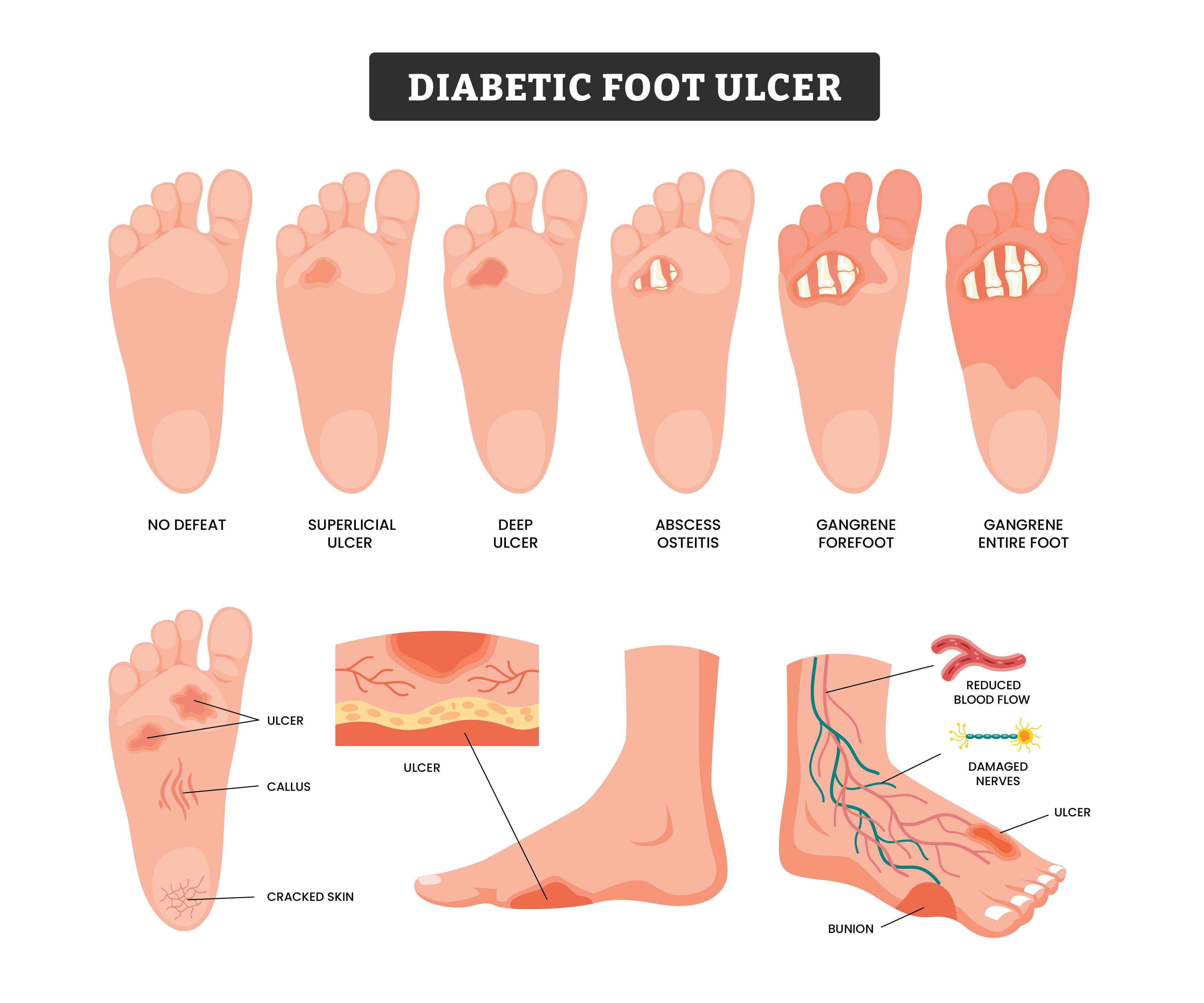 https://images.prismic.io/cls-health/Z22BN5bqstJ981sf_DiabeticFoot.jpeg?auto=format%2Ccompress
