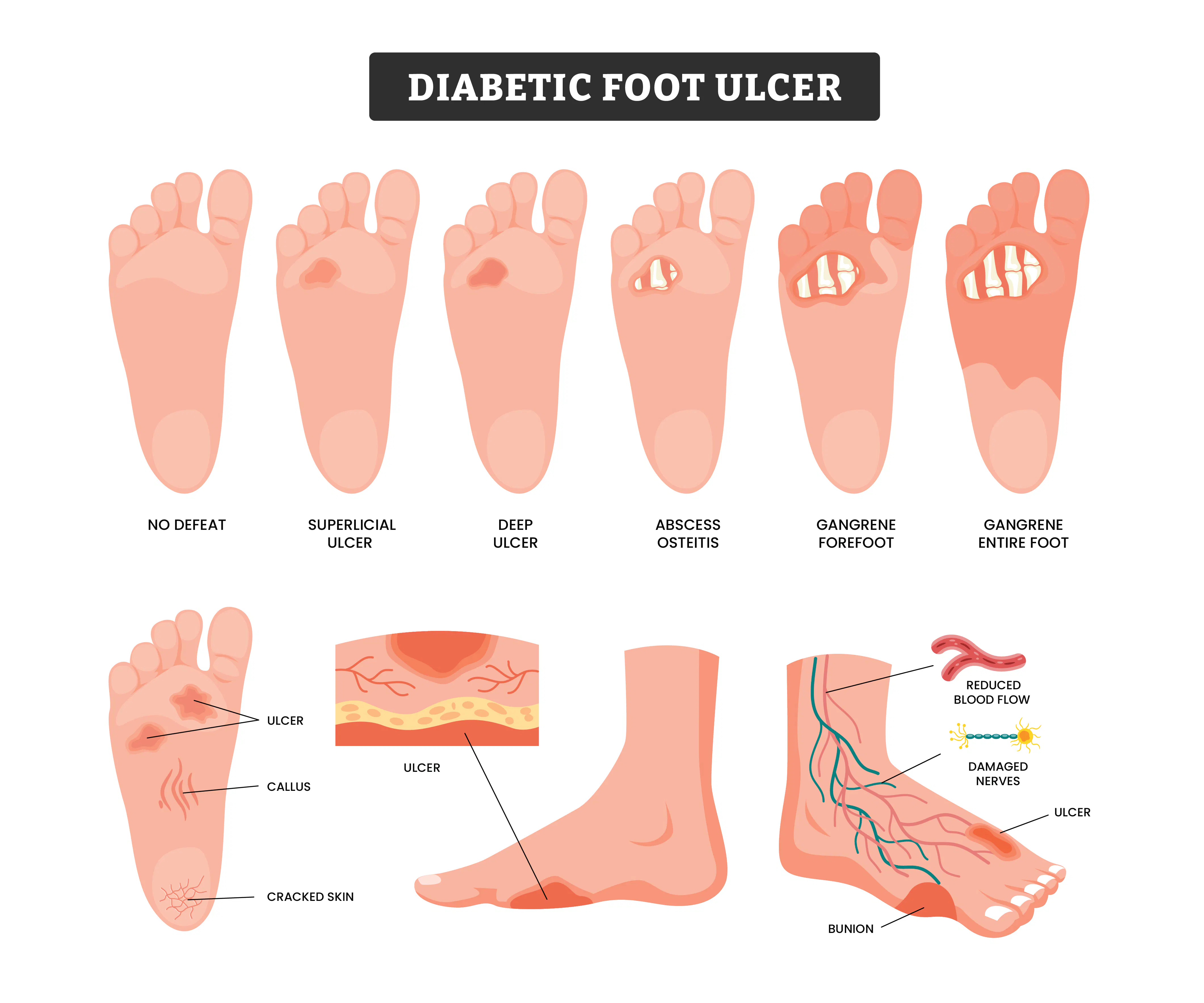 Early Signs Of Diabetic Feet In Women Symptoms Guide Early Signs Of Diabetic Feet In Women Symptoms Guide