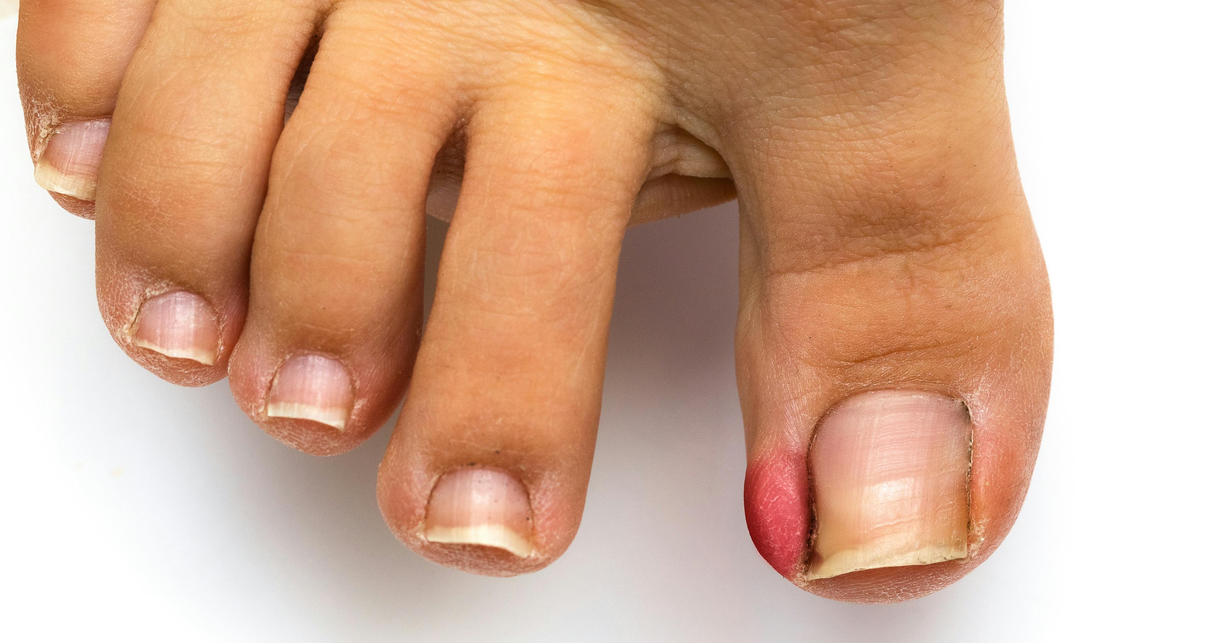 Inflammation on a big toe caused by an ingrown toenail.