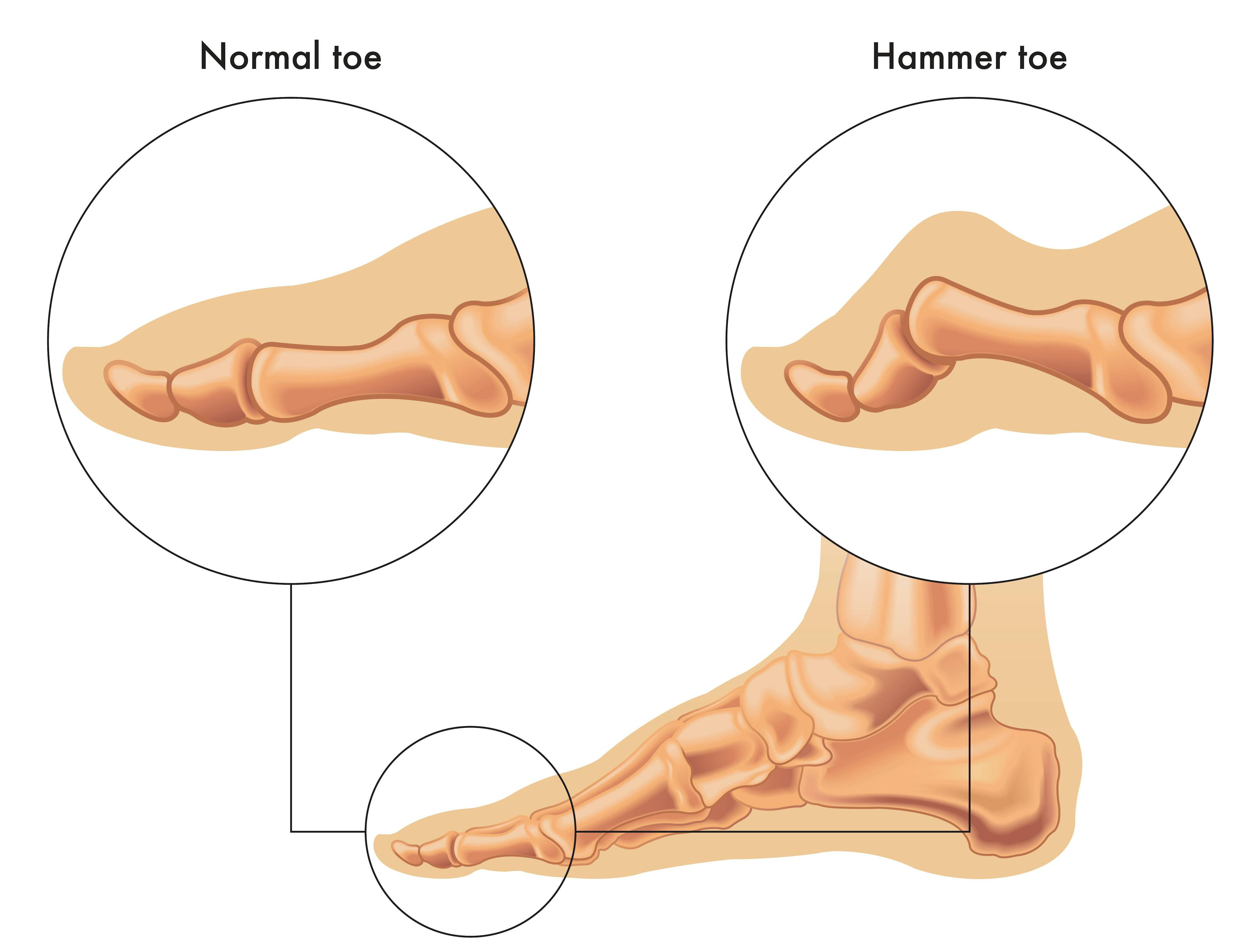 Illustration contrasting a foot with a normal with a foot presenting a hammertoe.