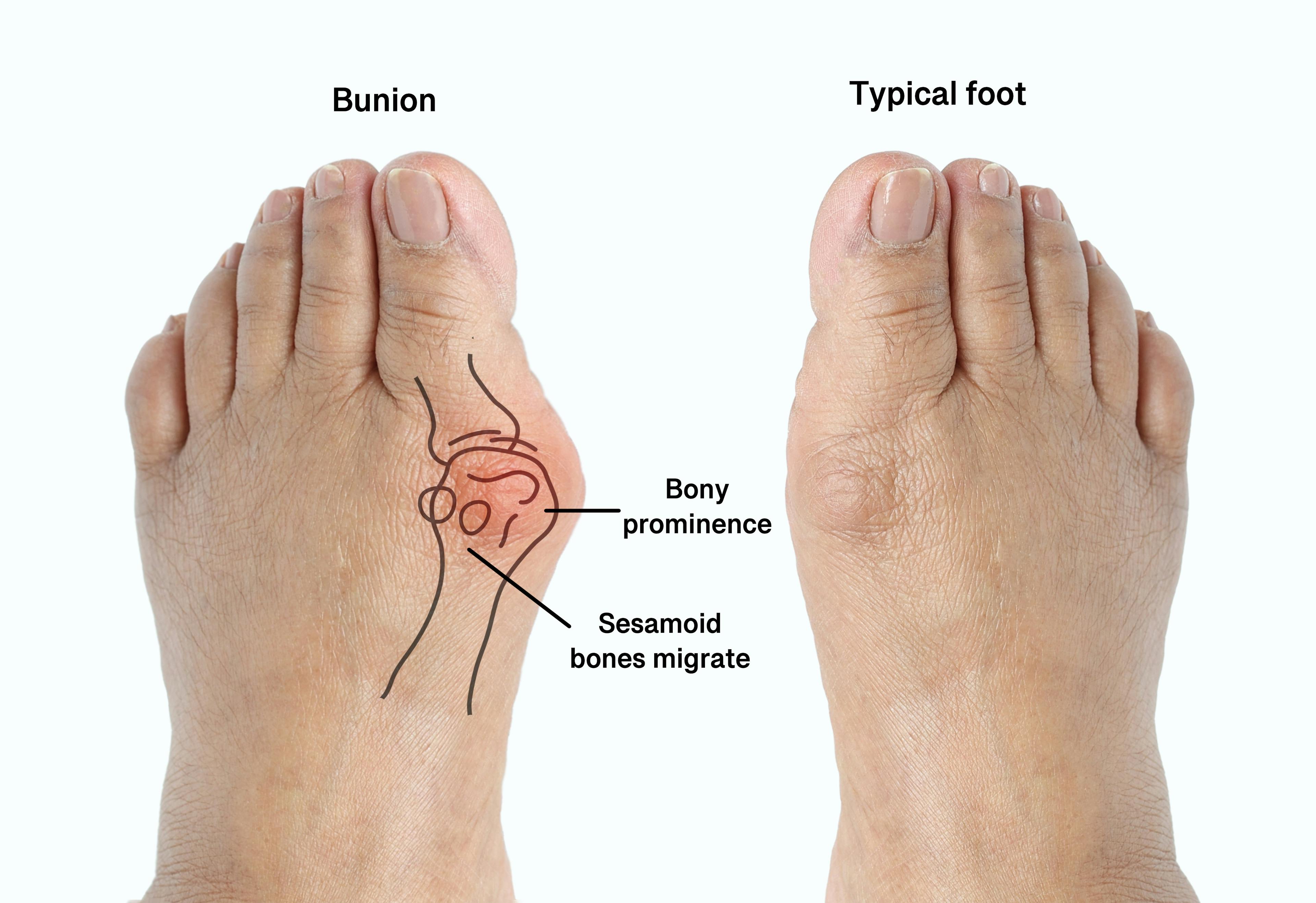 A foot presenting a bunion next to a normal foot.