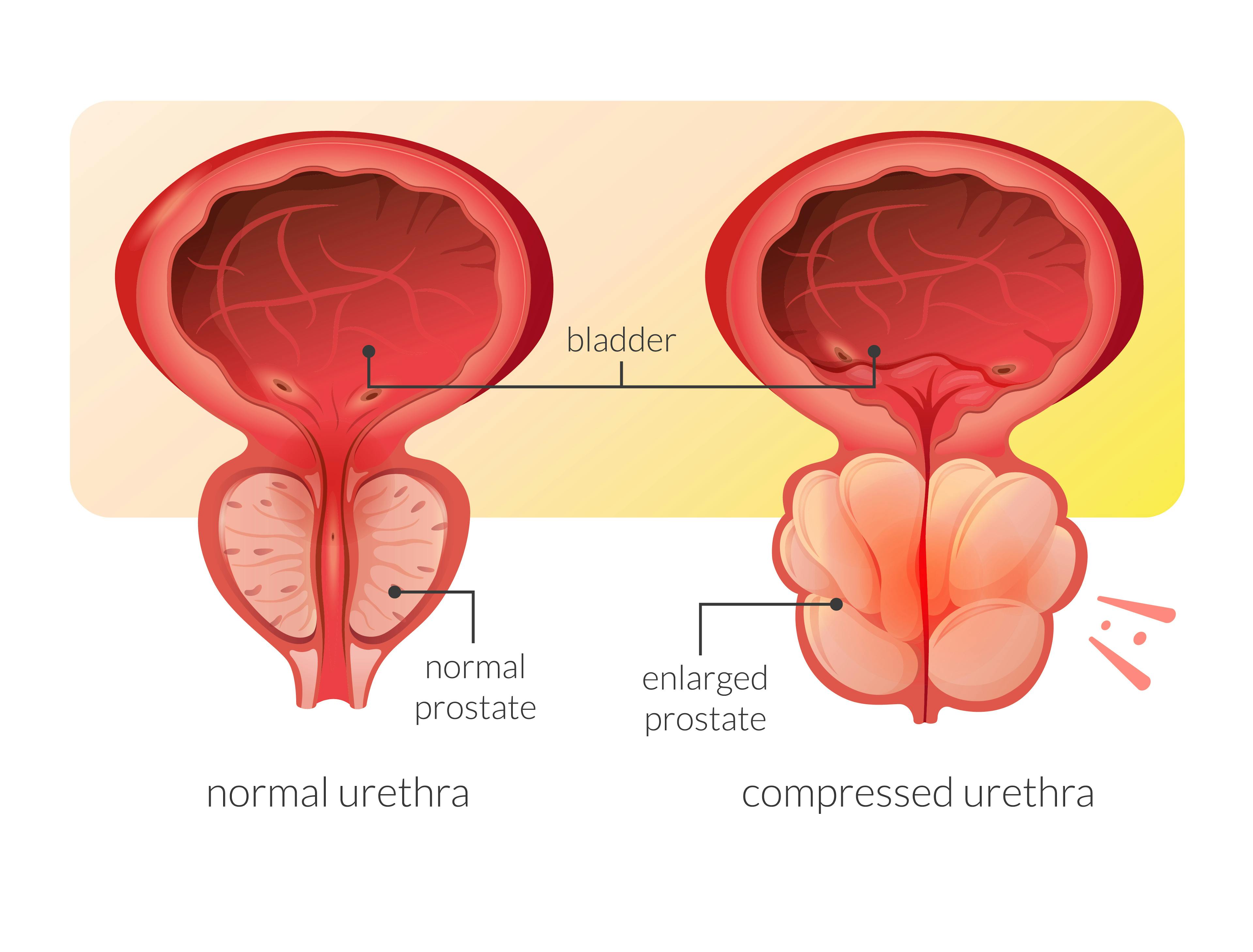 A normal prostate juxtaposed with an enlarged prostate.