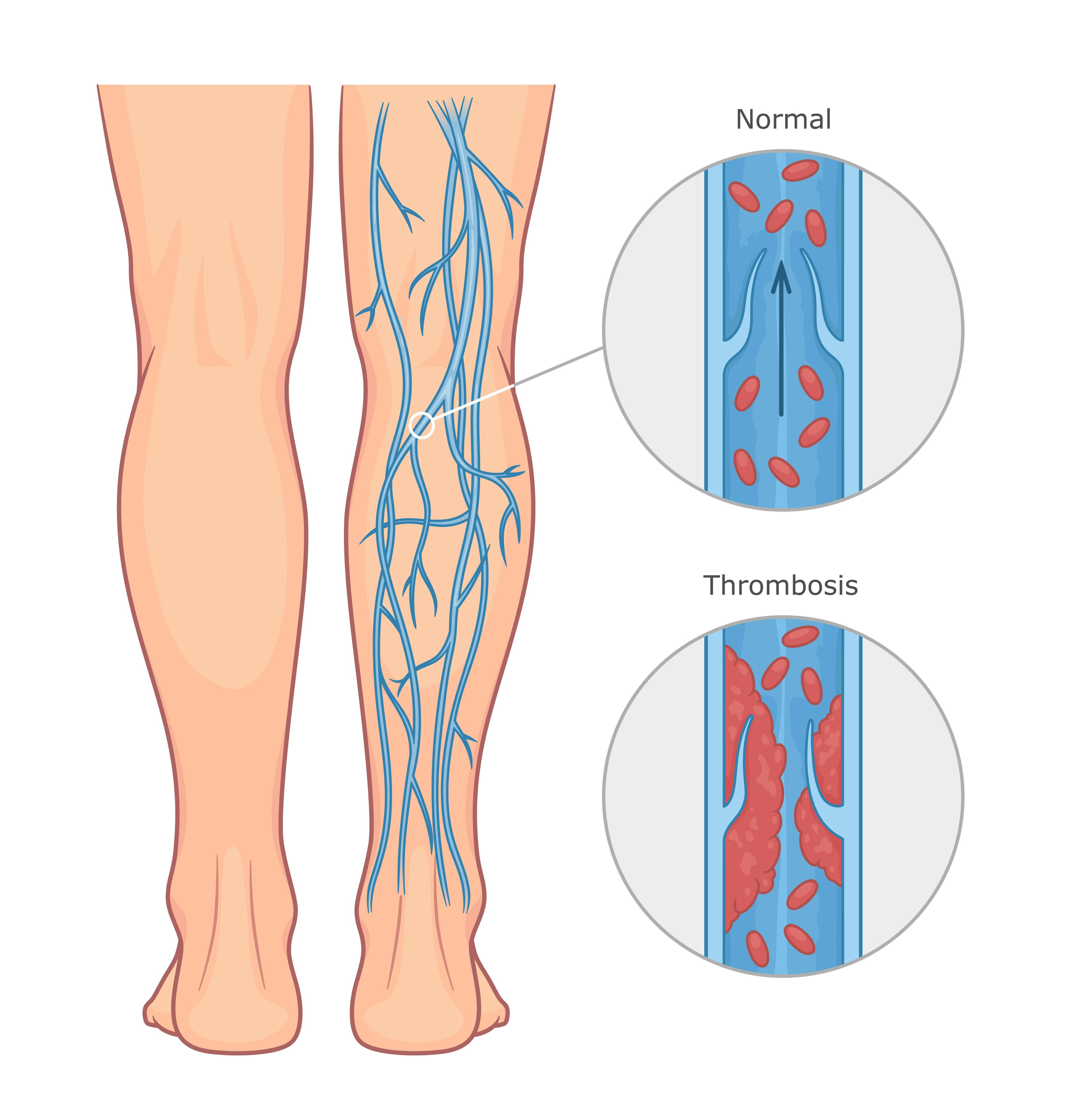 A leg with normal veins next to a leg presenting Deep Vein Thrombosis (DVT).