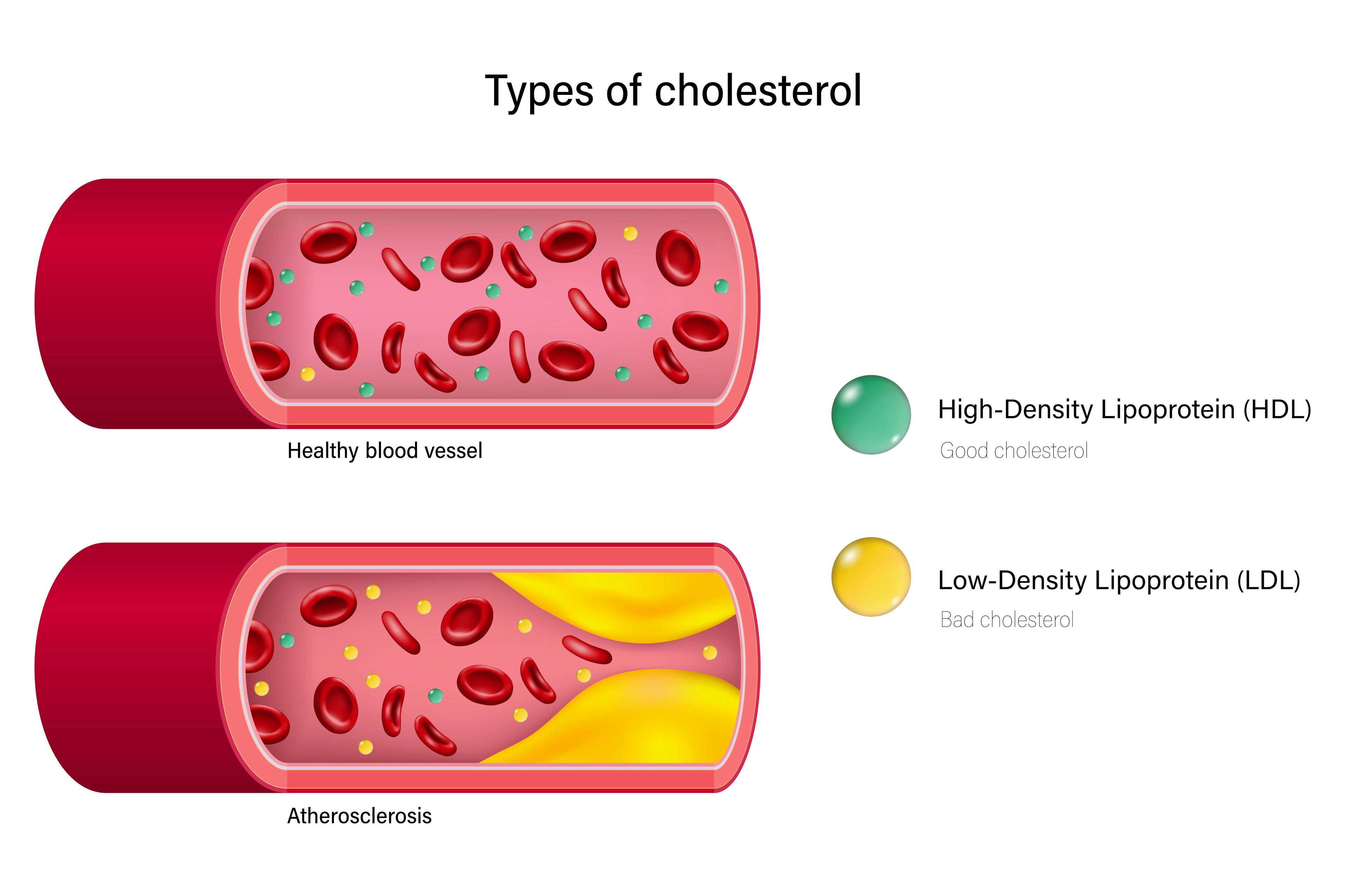 A healthy blood vessel contrasted with an unhealthy vessel that shows a build up of cholesterol.