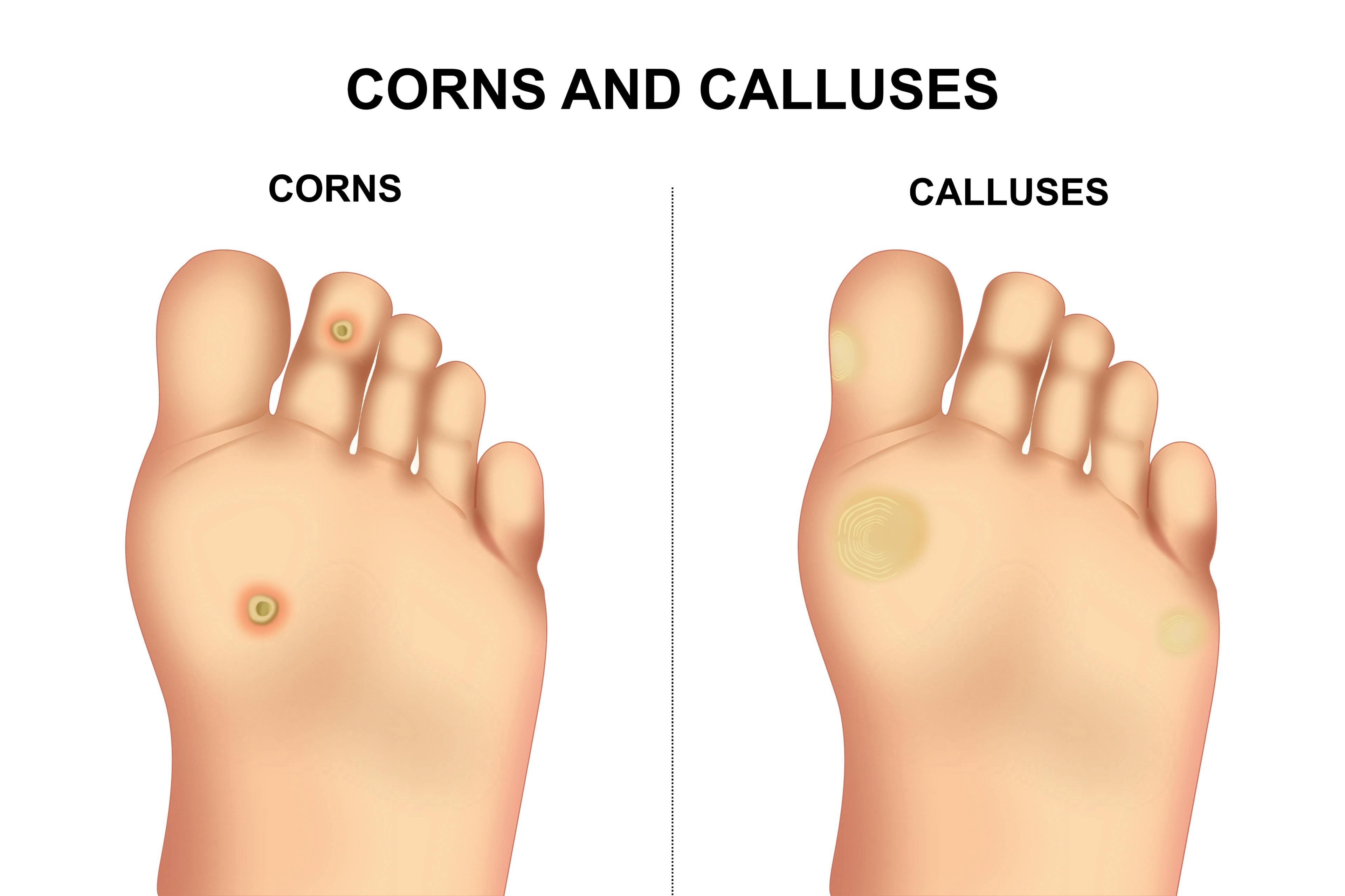 An illustration of a foot with a corn next to an illustration of a foot with a callus.