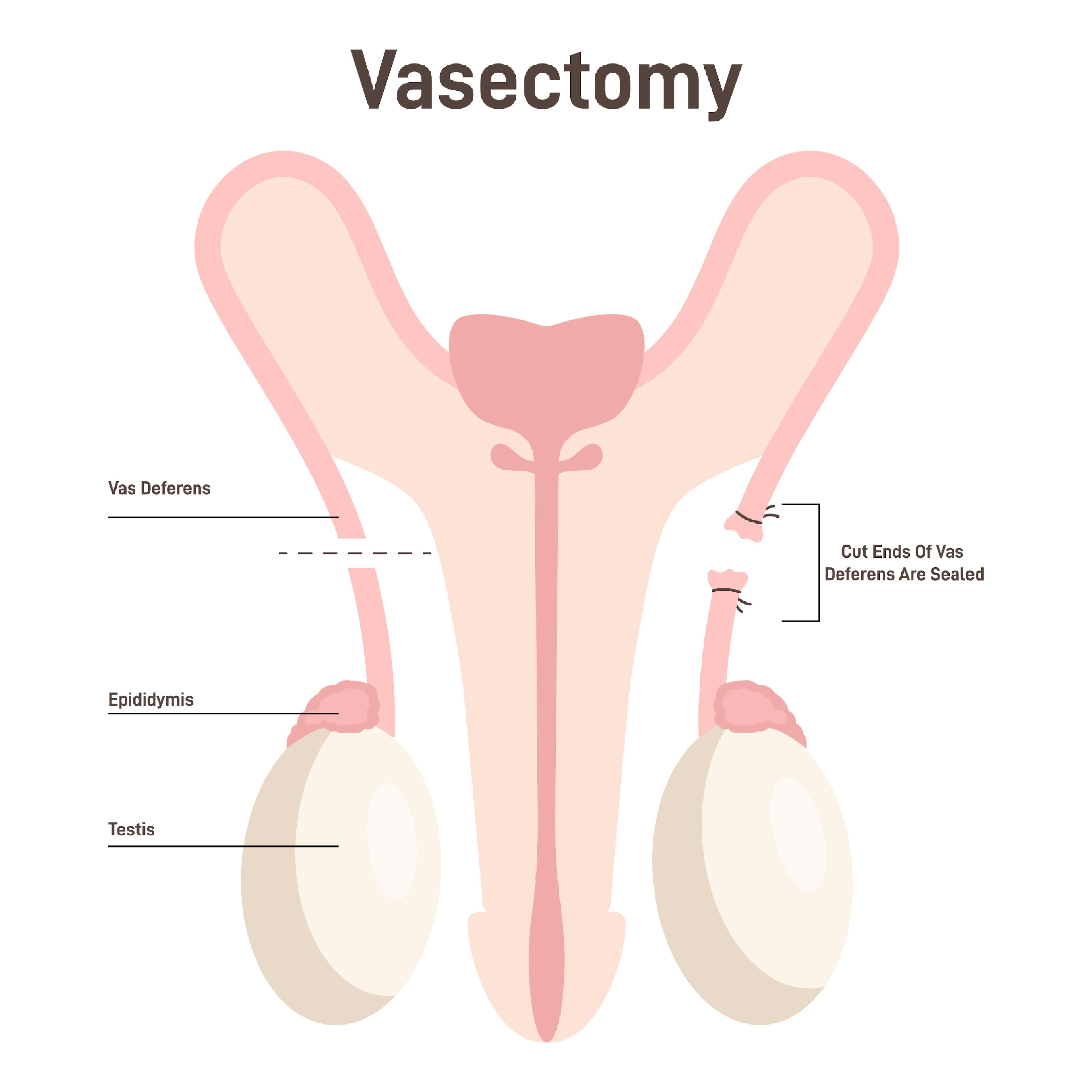 Illustration of the cut ends and sealing of the Vas Deferens.