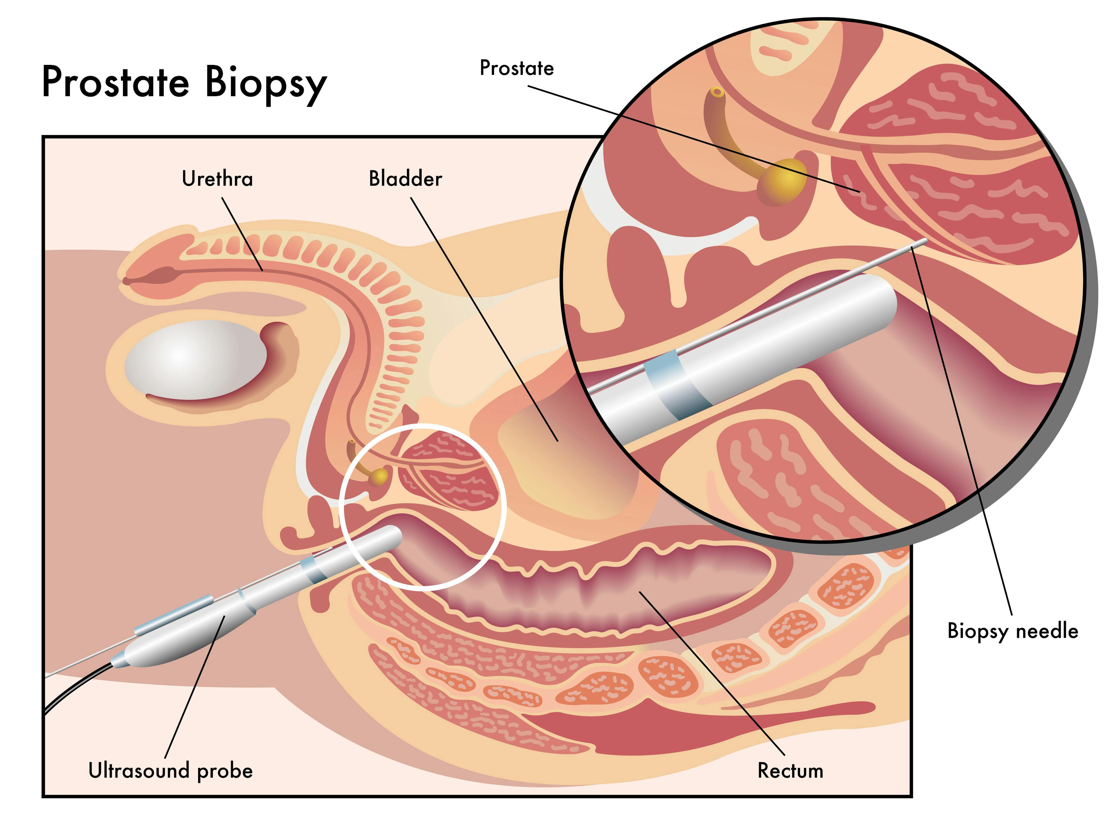 Illustration of a prostate biopsy procedure.
