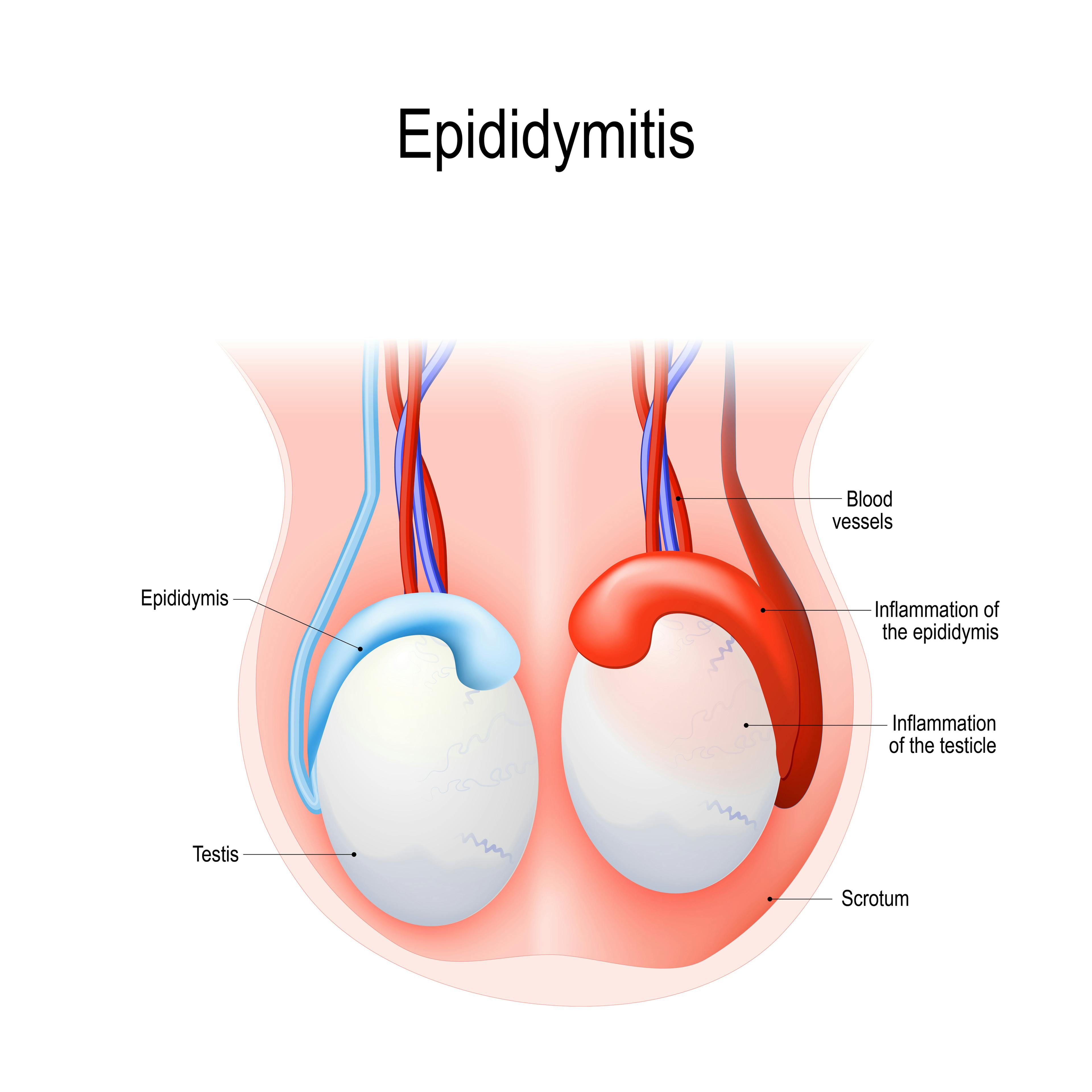 Illustration of a normal testicle contrasted with an inflamed testicle showing epididymitis.