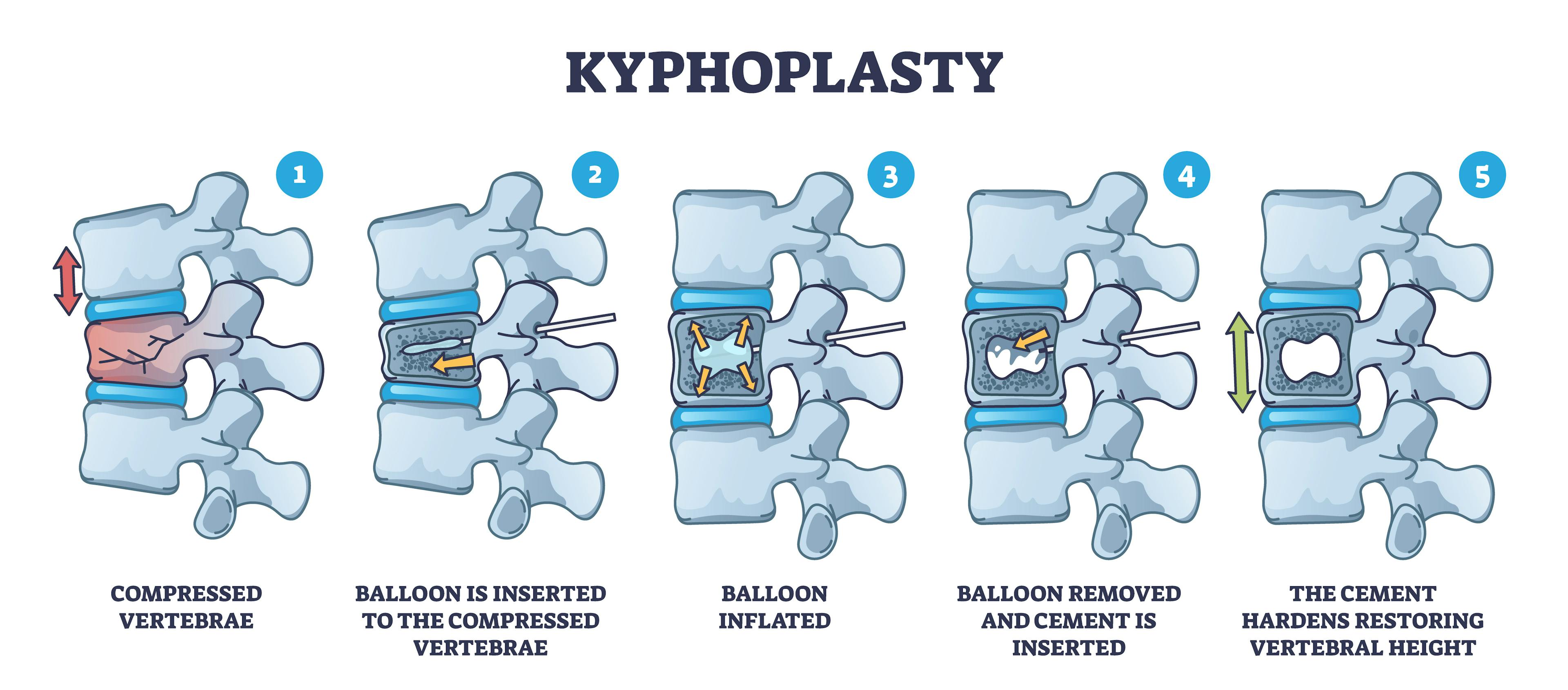 Illustration of kyphoplasty procedure on compressed vertebrae, including the insertion of a balloon and cement.