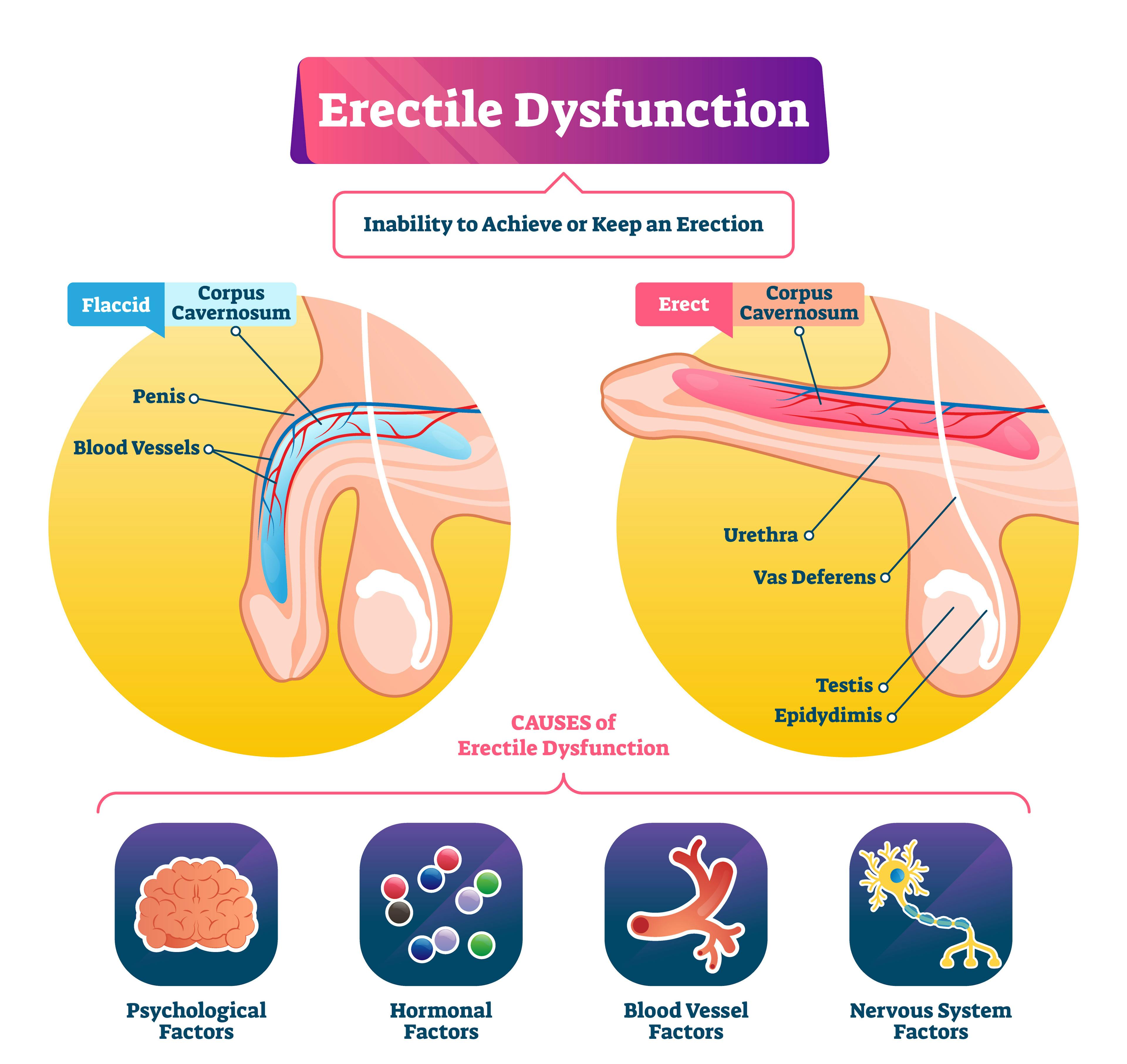 Erectile dysfunction diagram of flaccid penus and erect penus with icons below representing the various causes of the condition.