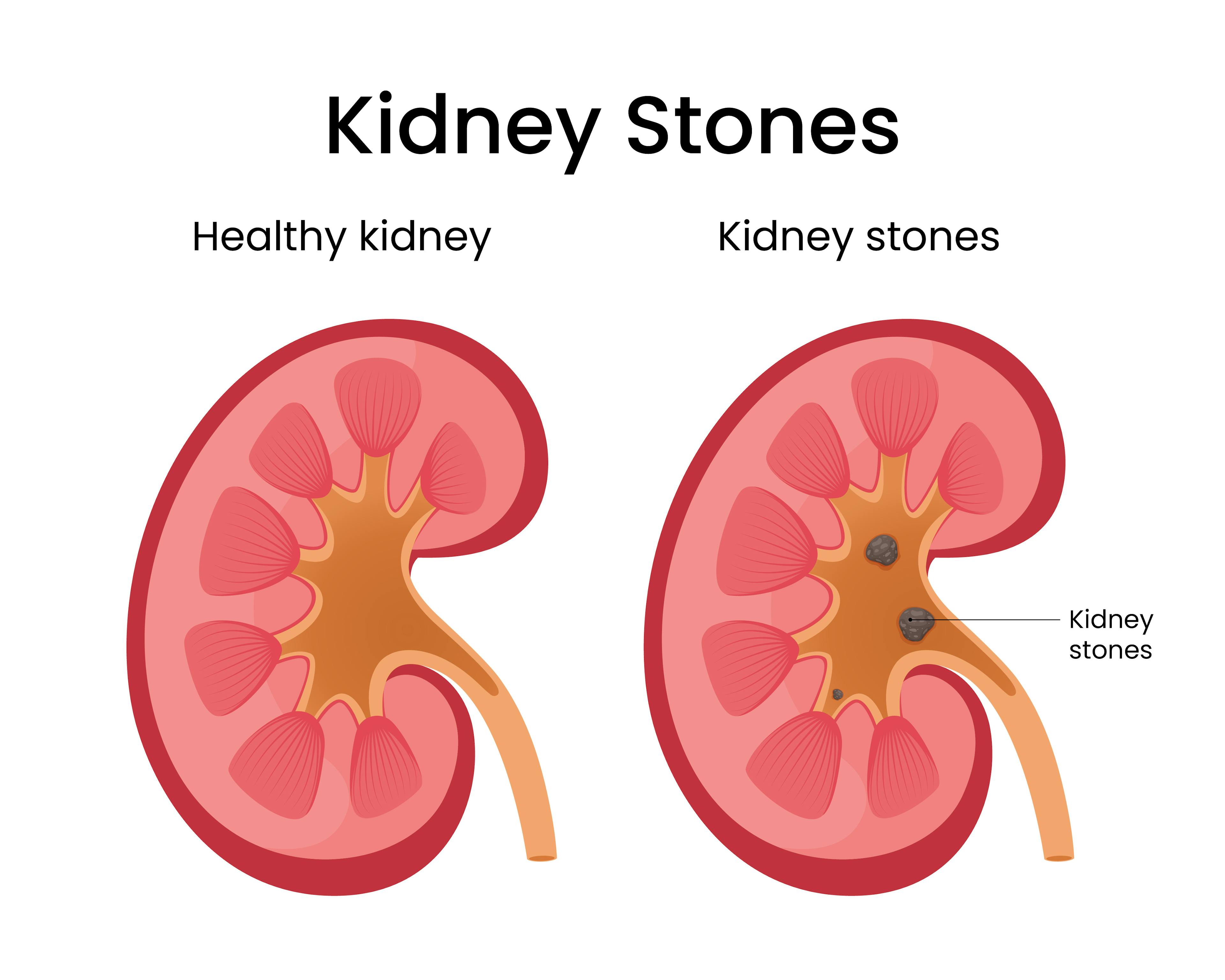 Illustration of a healthy kidney next to one with kidney stones.