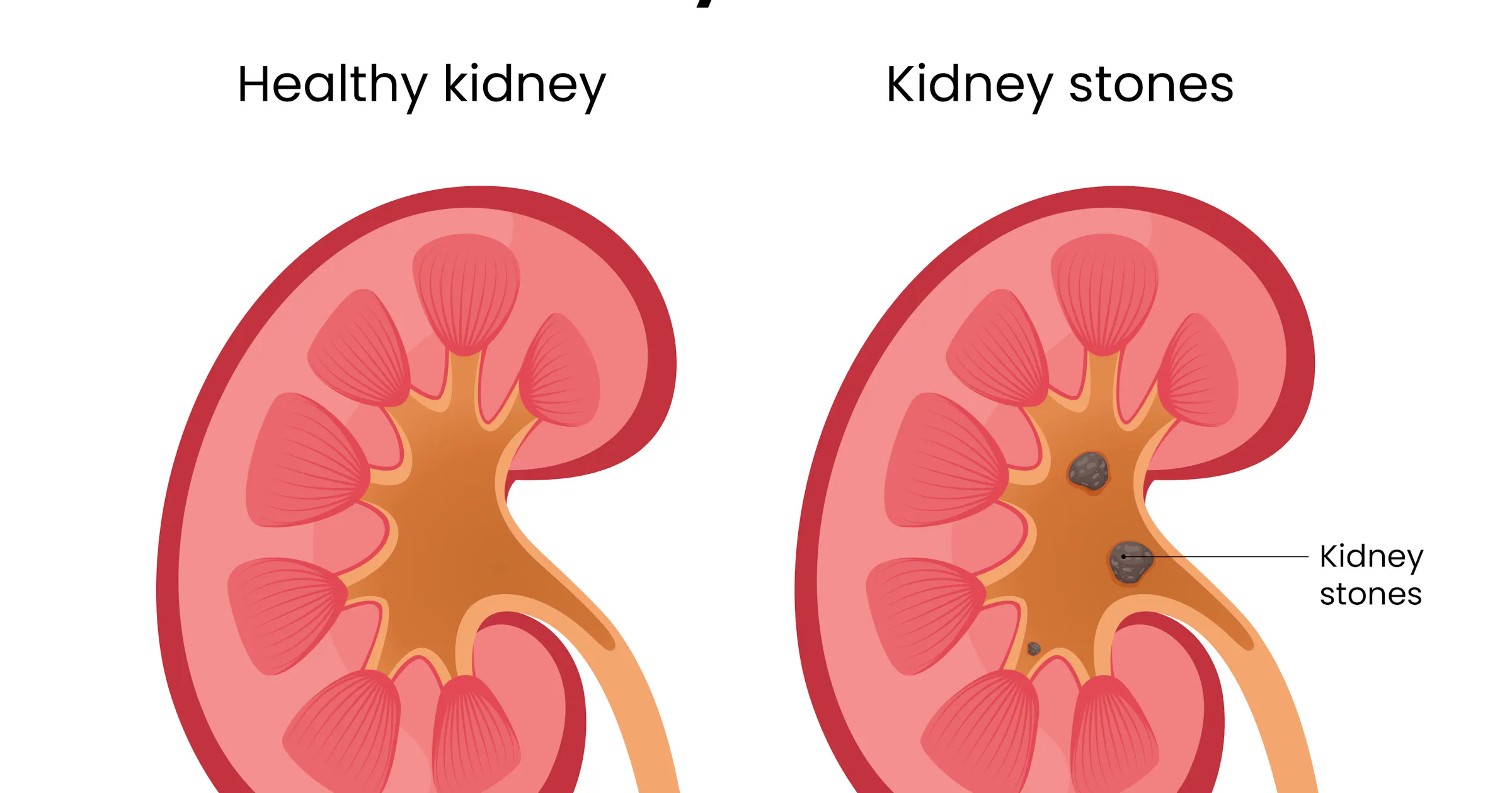 Kidney Ridge Kidney Stone Treatment | Expert Care & Information | CLS Health