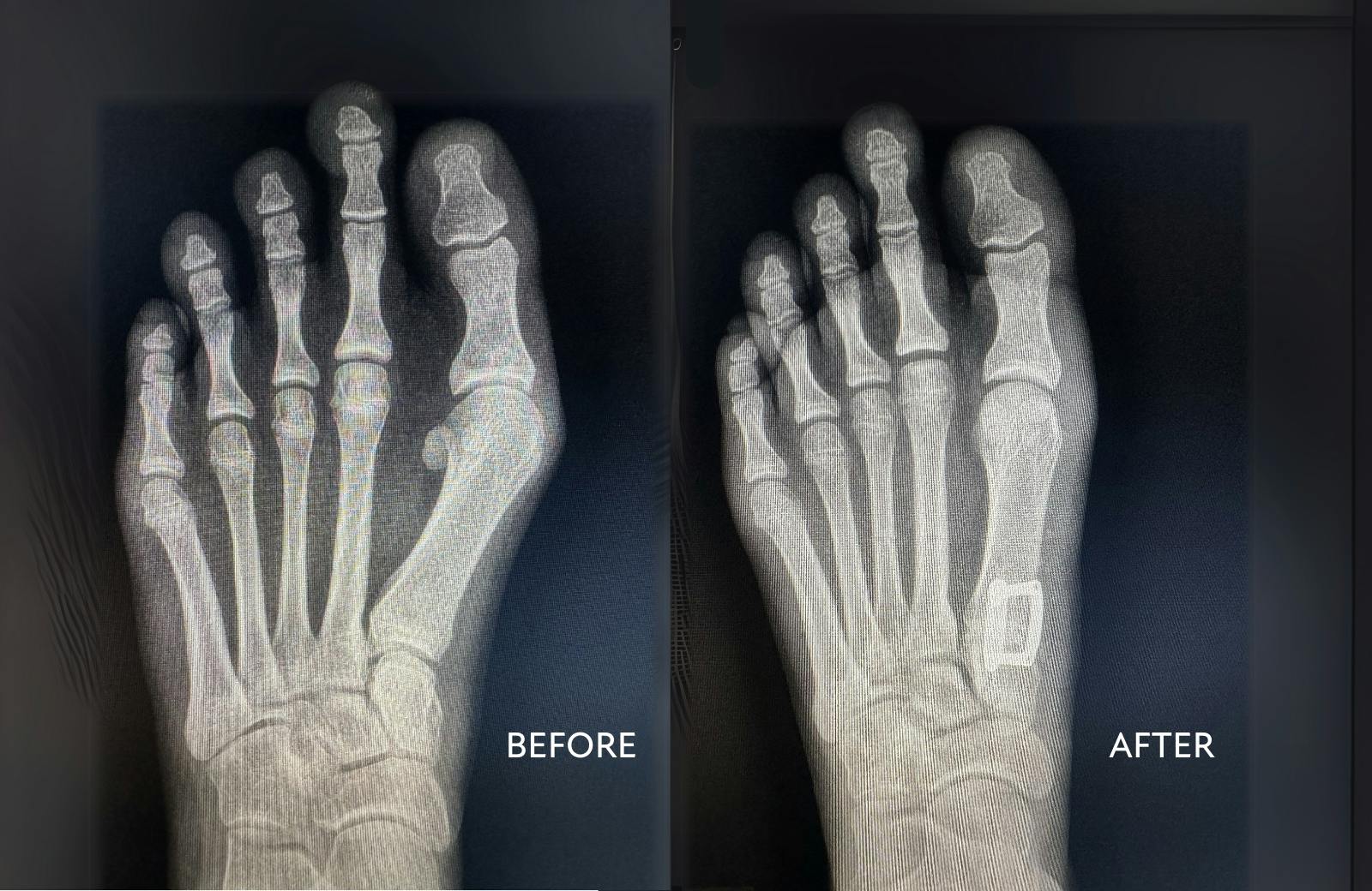 A before and after photo of a patient's foot x-ray following bunion surgery.