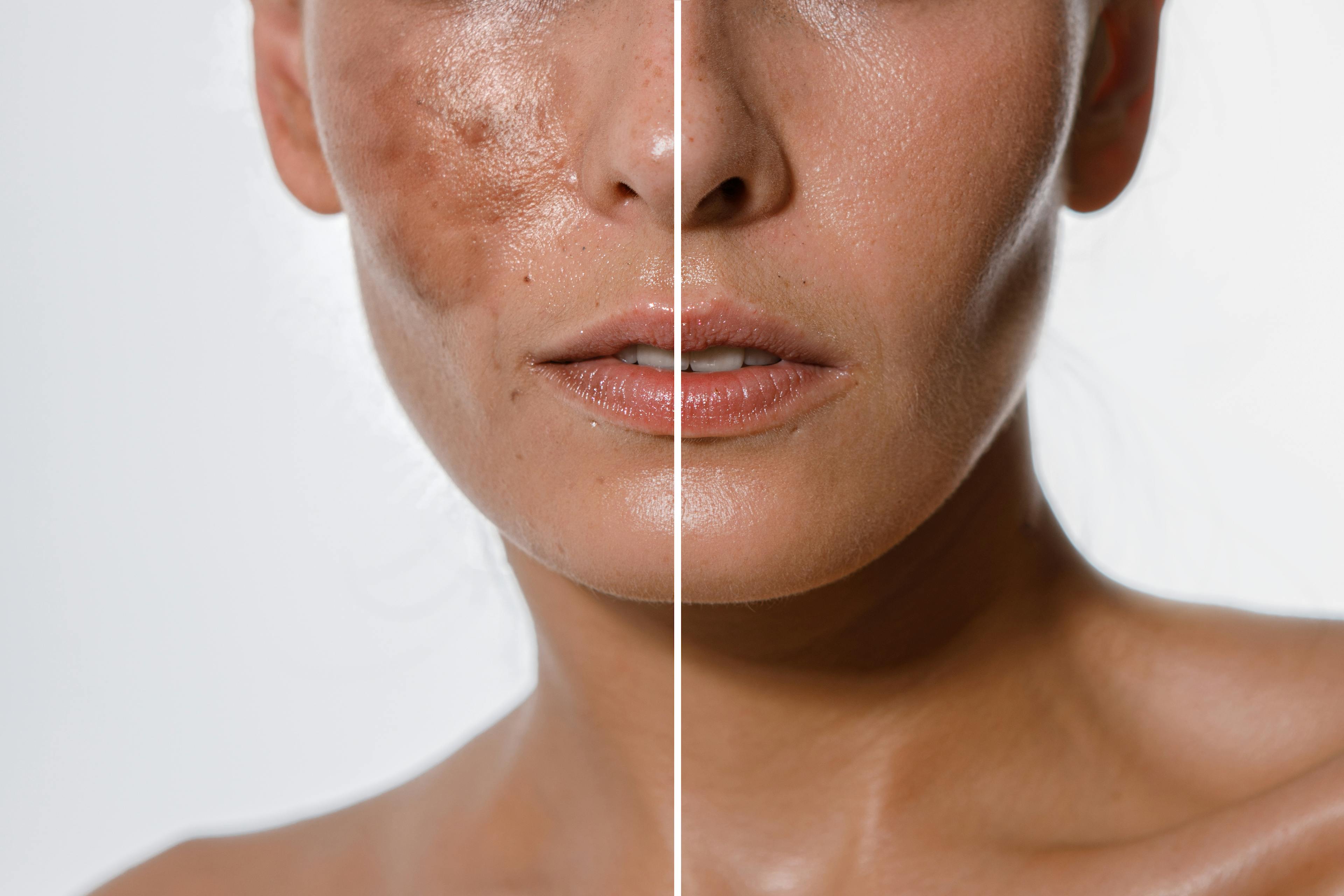 Before and after photos of a woman's face showing reduced hyperpigmentation after treatment with the DermaV laser.