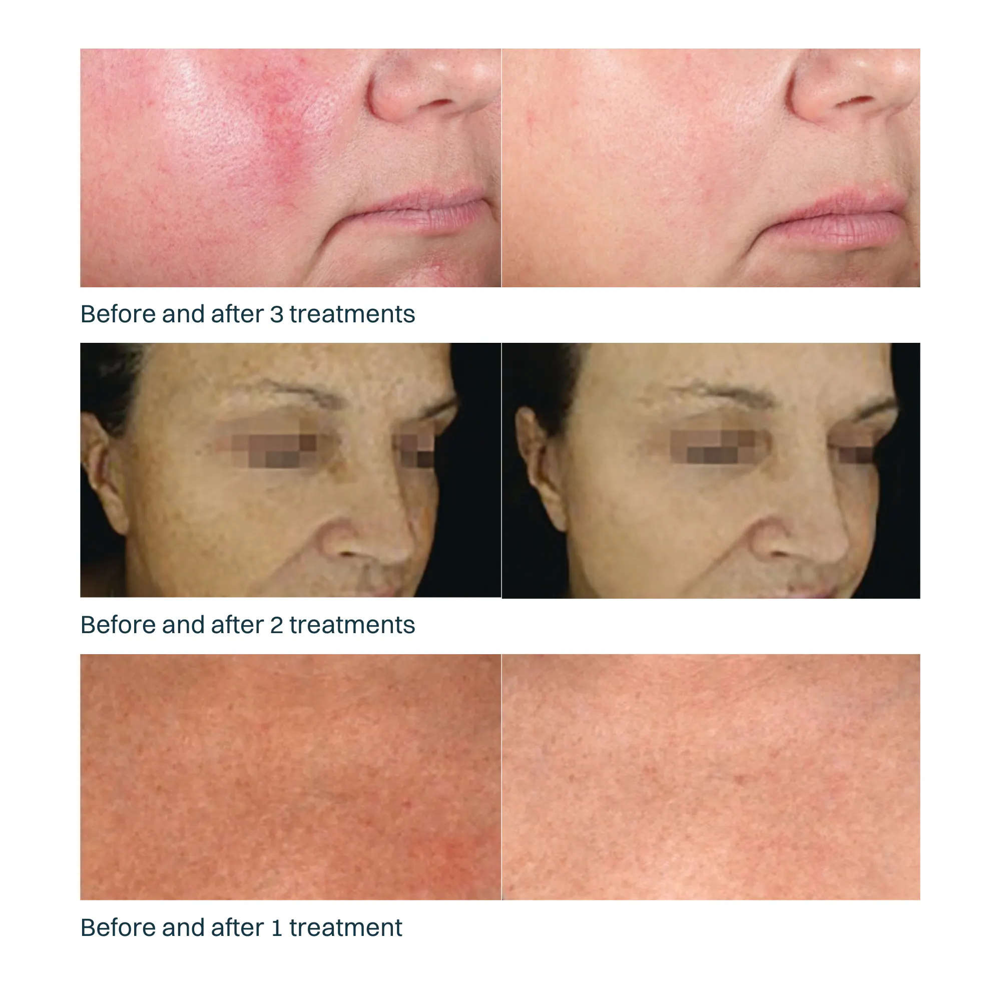 Before and after photos of patients who have received Derma V cosmetic laser treatments, showing impressive results.