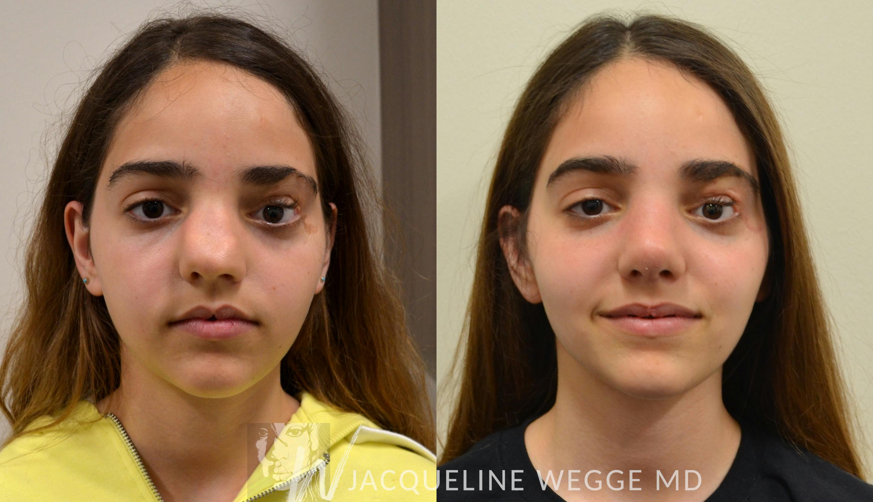 Close-up of an adolescent female's face before and after rhinoplasty procedure.