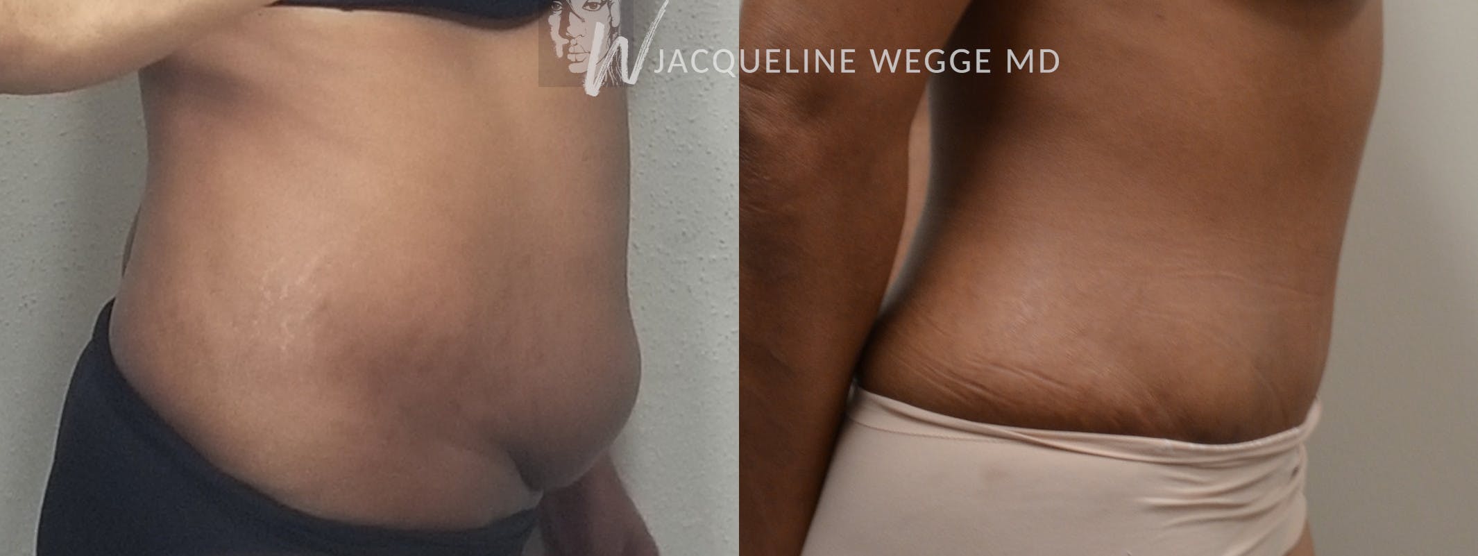Close-up of a female patient's torso before and after a "tummy tuck" procedure.