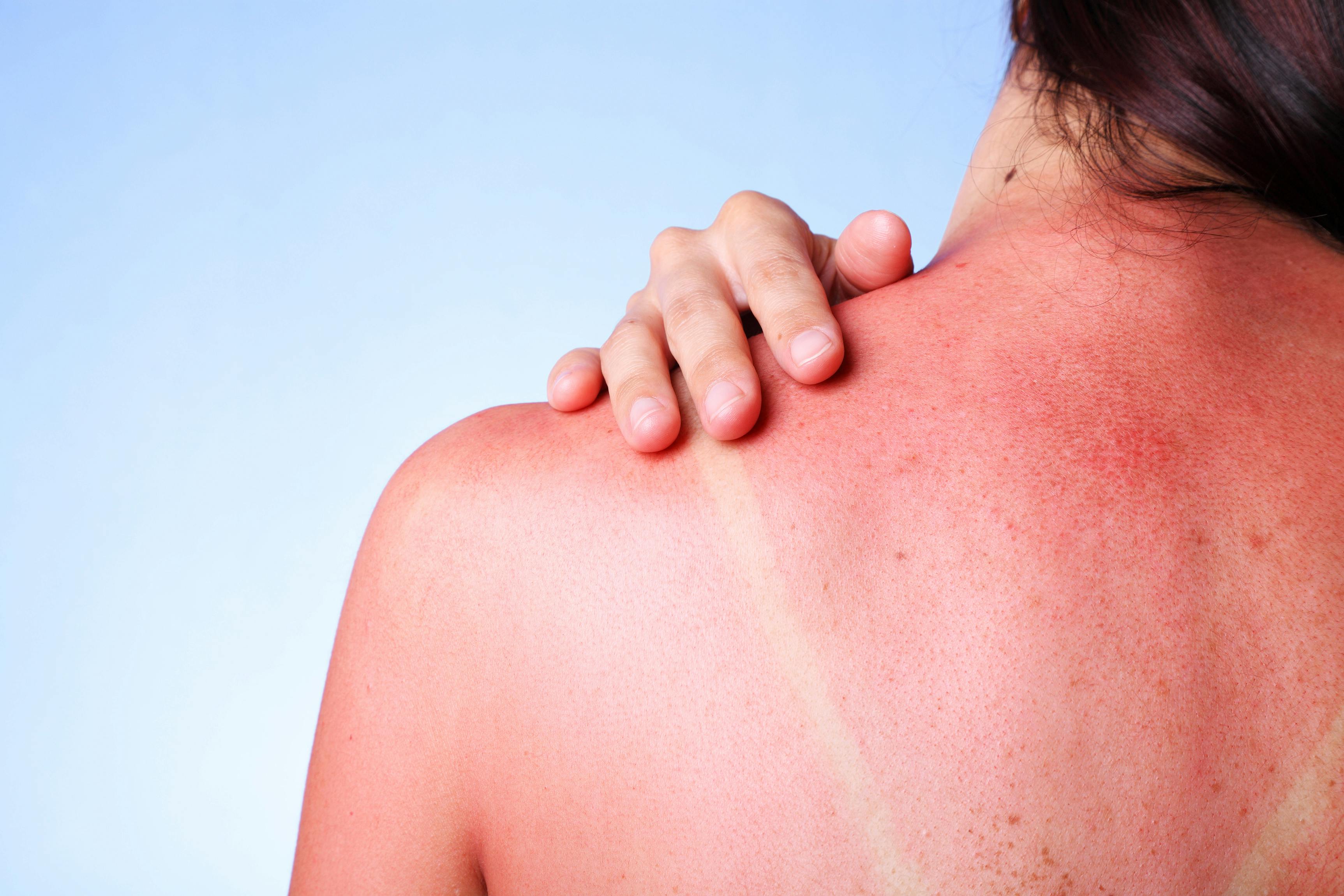 A female touching her sunburned shoulder.