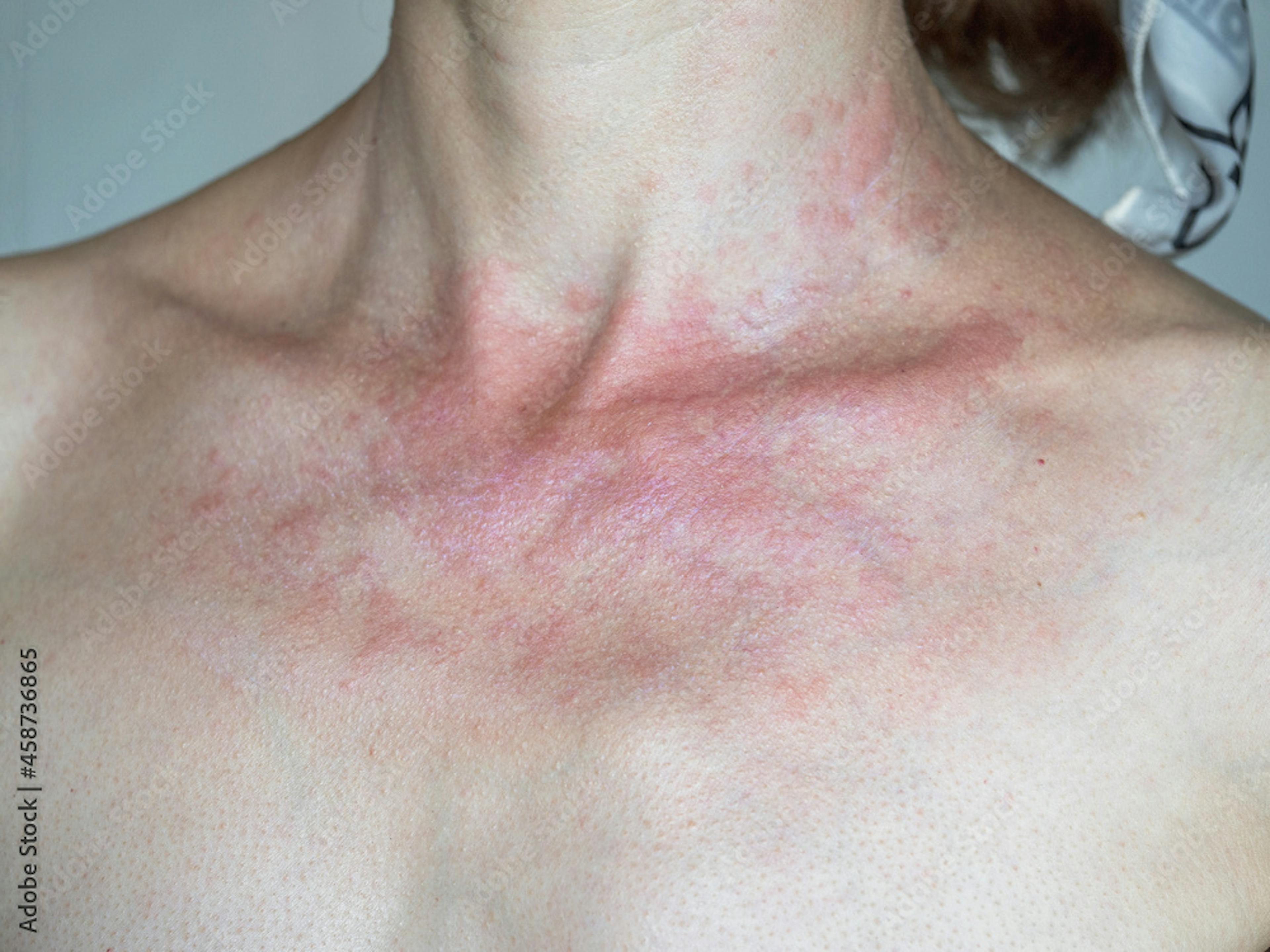 Solar dermatitis. Woman with red sunburned skin against gray background, close-up.
