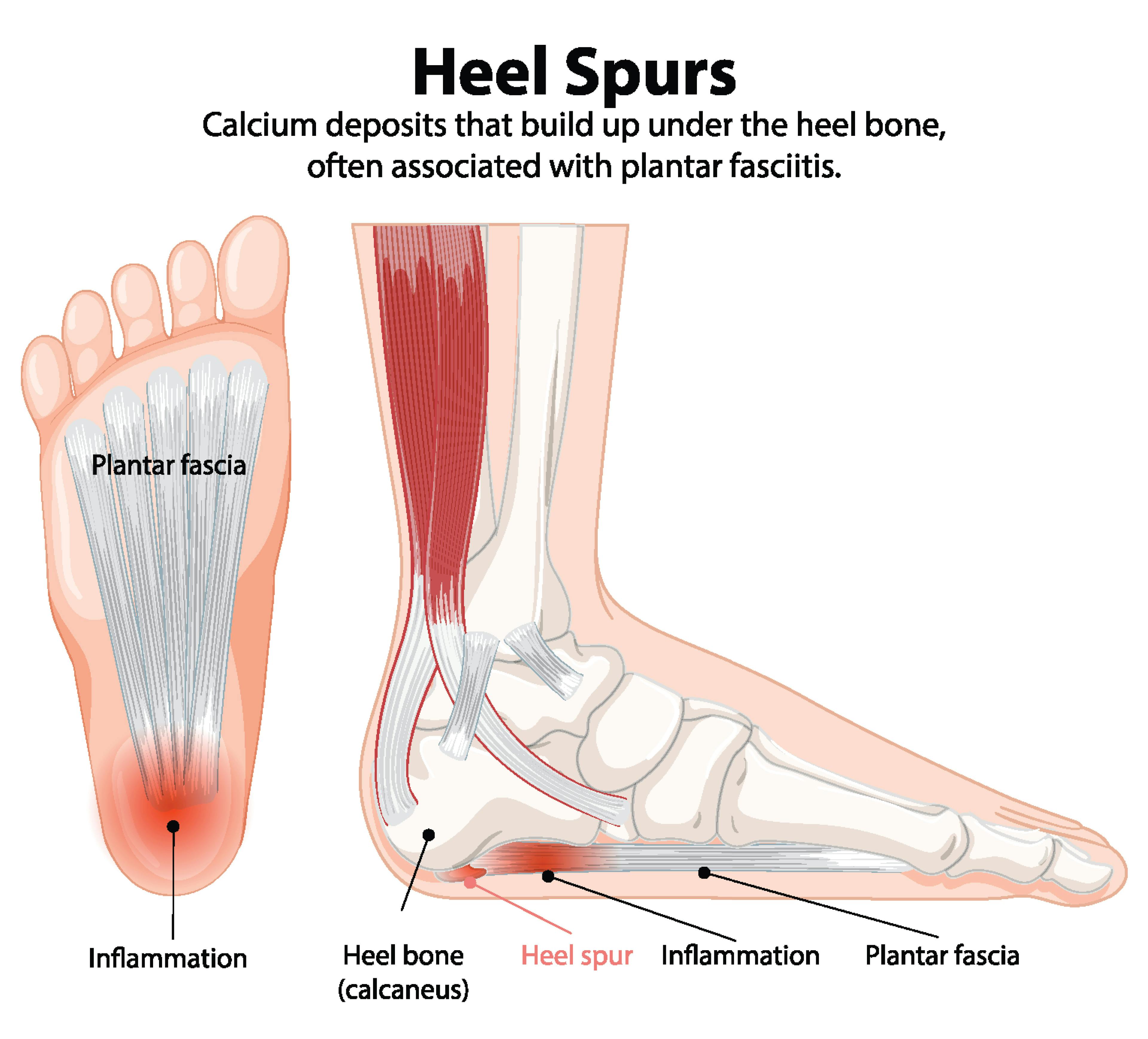 Illustration of heel spurs and plantar fasciitis