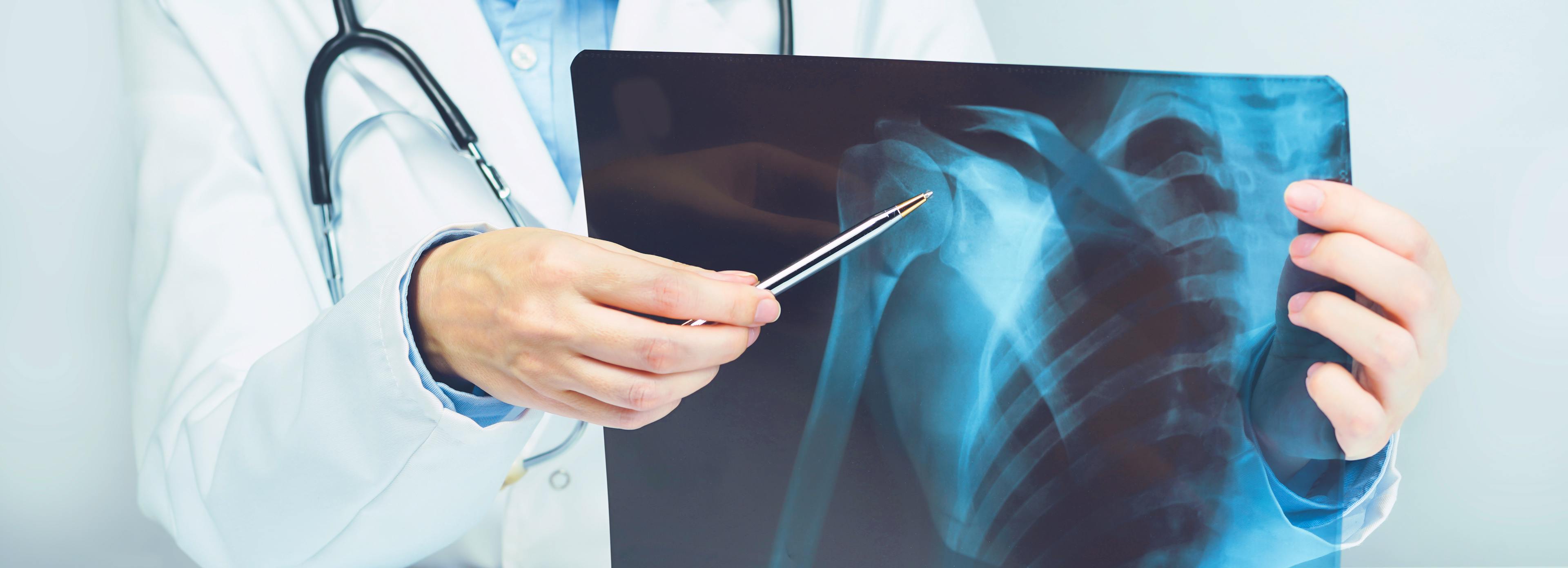 Female doctors hand pointing at x-ray medical imaging with a shoulder condition.