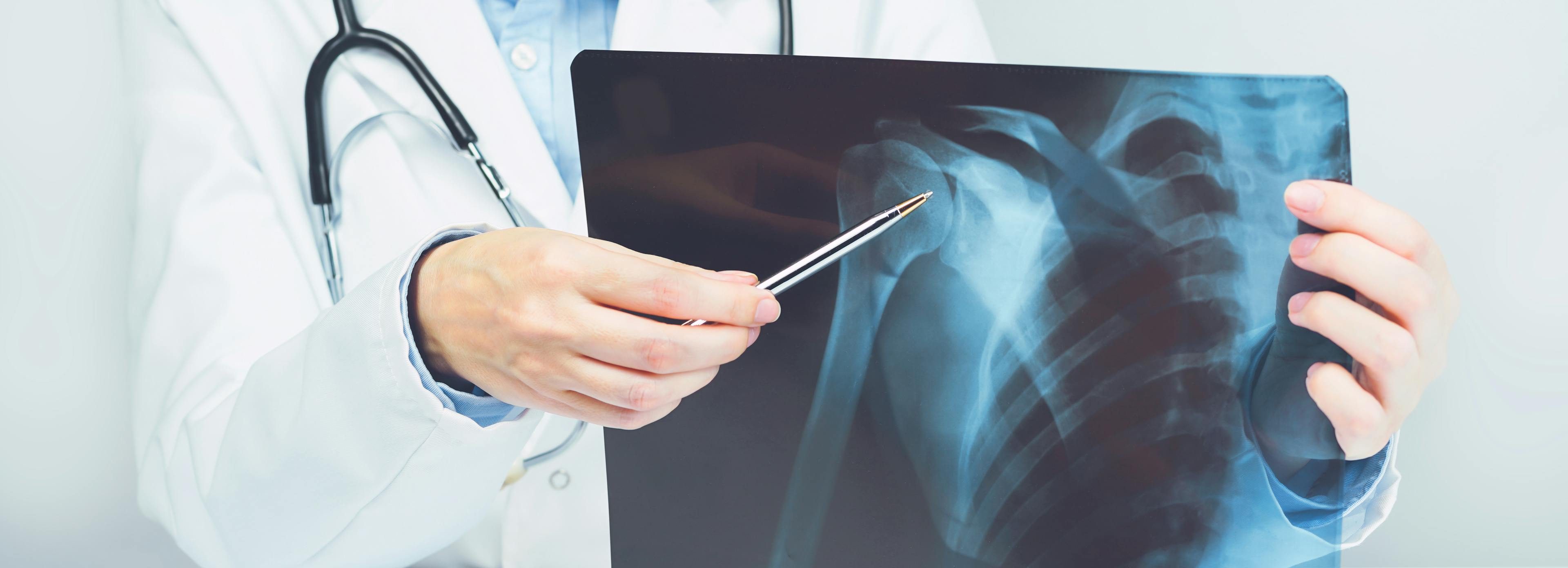 Female doctors hand pointing at x-ray medical imaging with a shoulder condition.