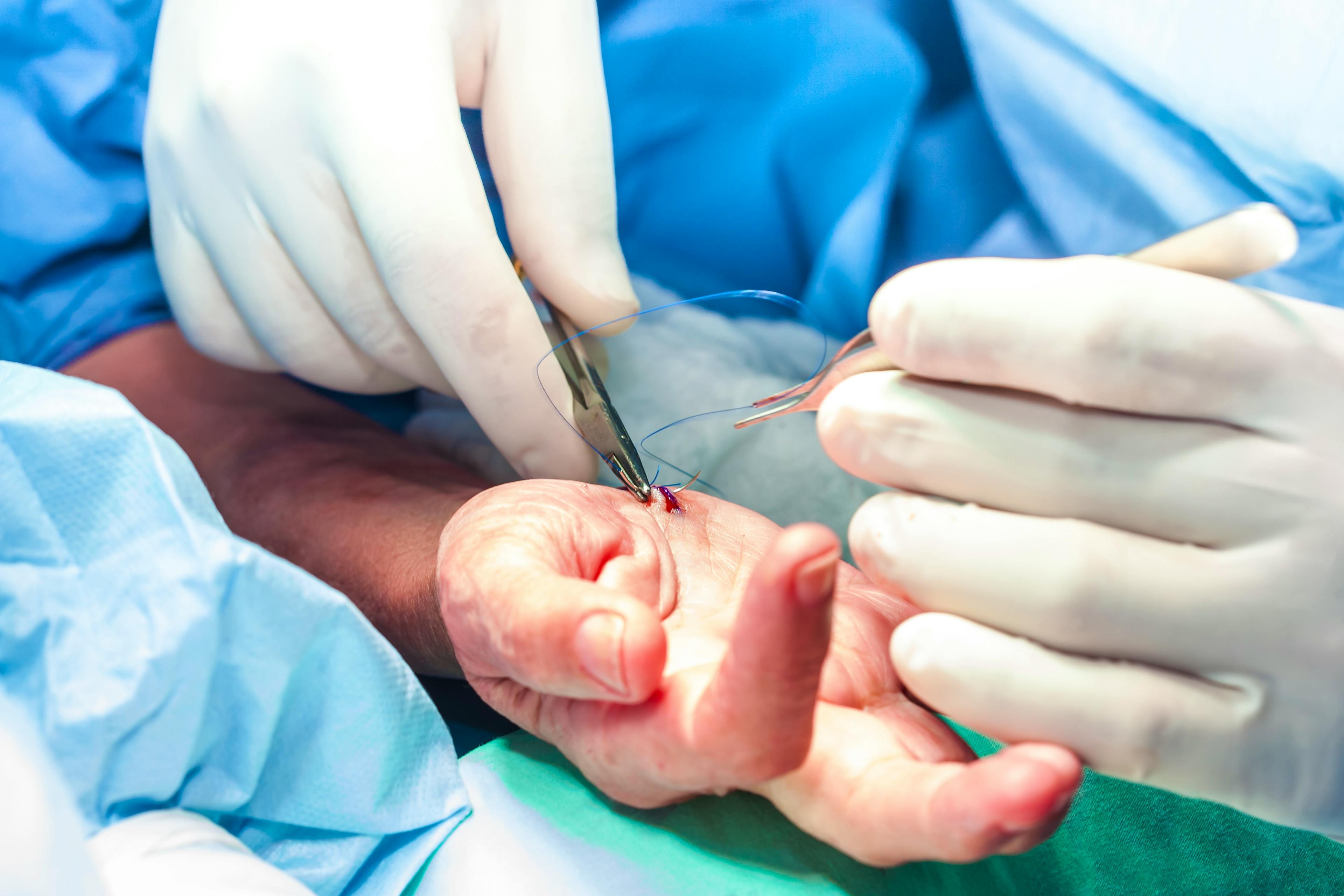Surgeon suturing the hand of a patient at the end of surgery.