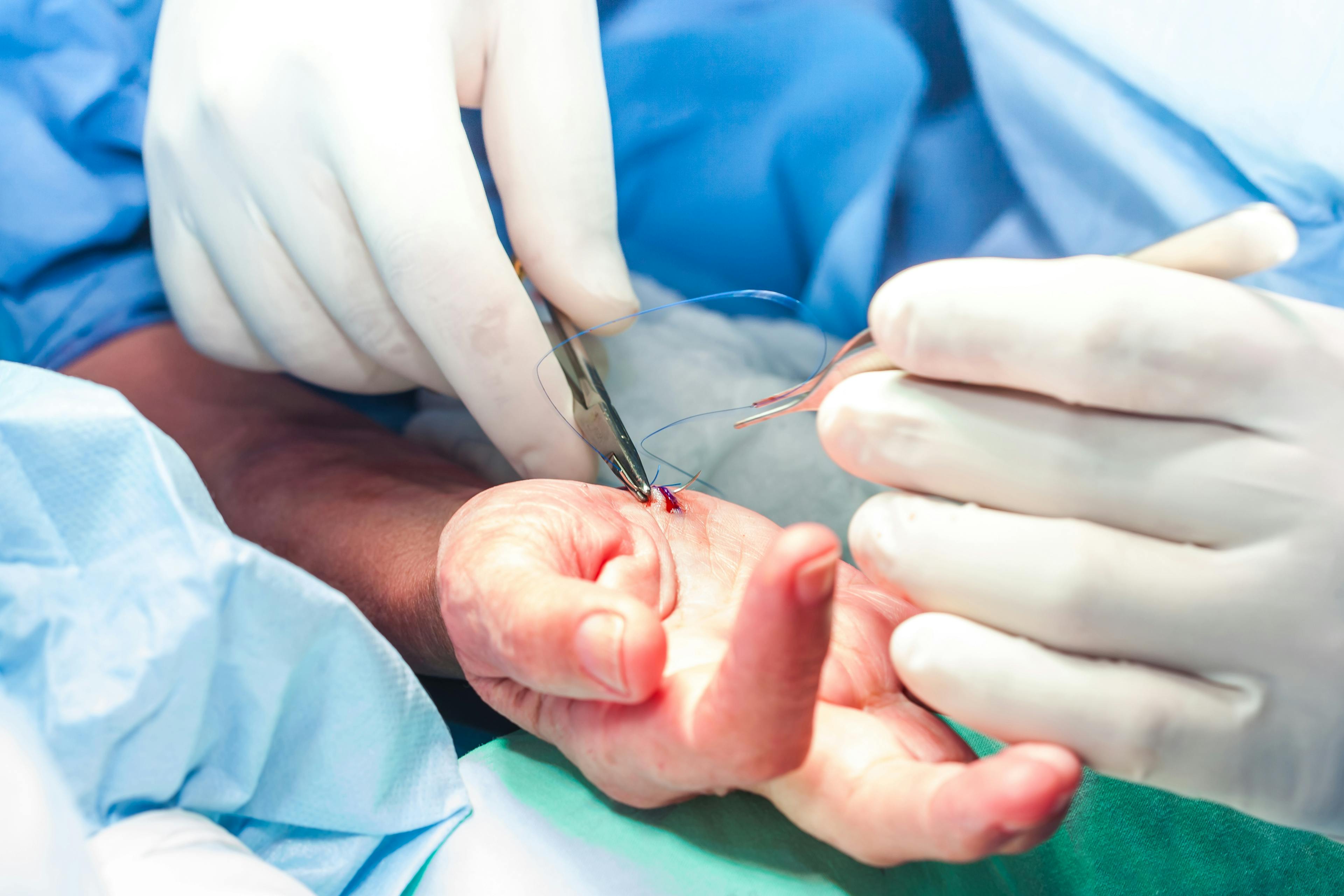 Surgeon suturing the hand of a patient at the end of surgery.