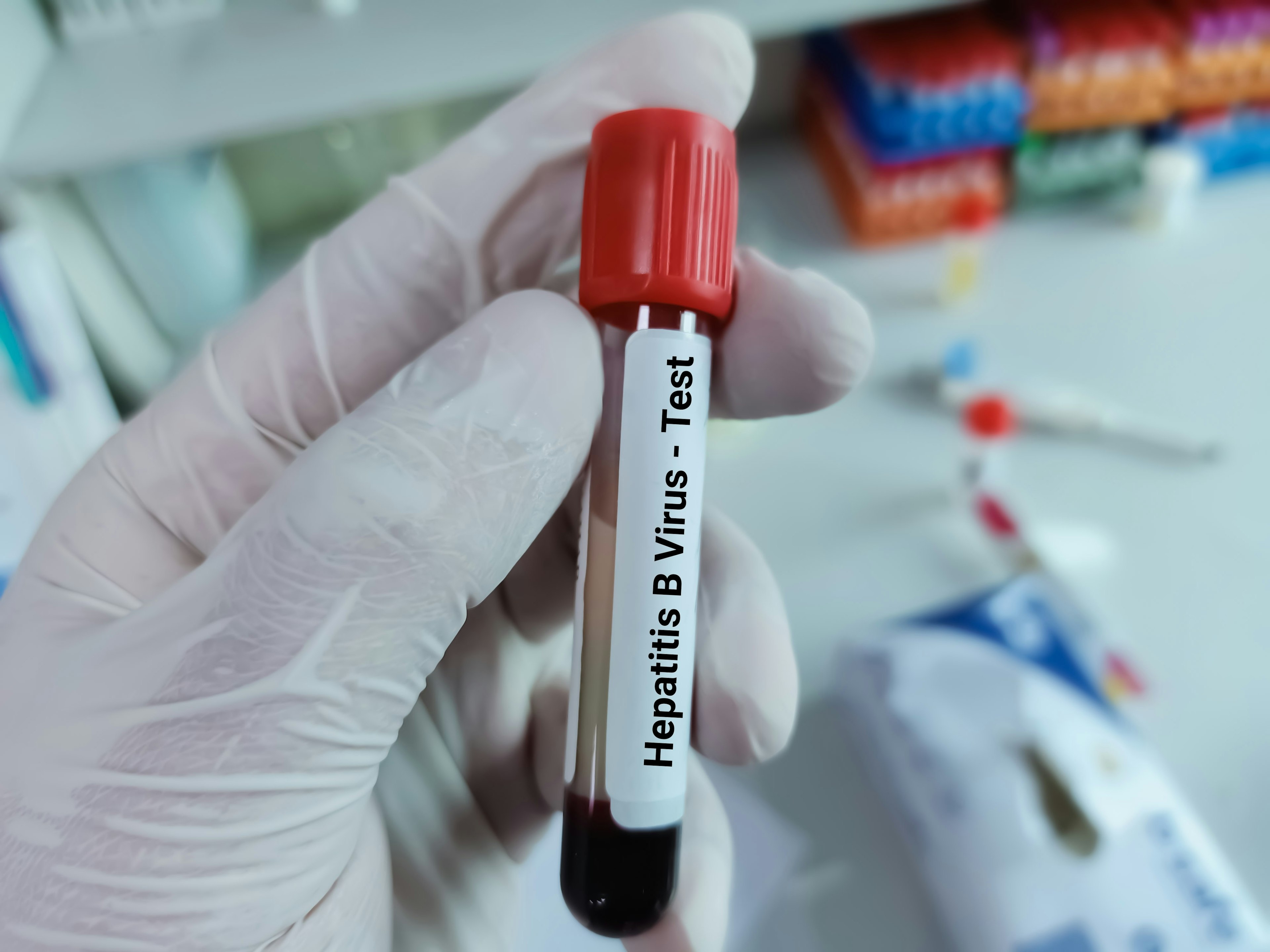 Doctor holds blood sample in test tube for Hepatitis B virus.