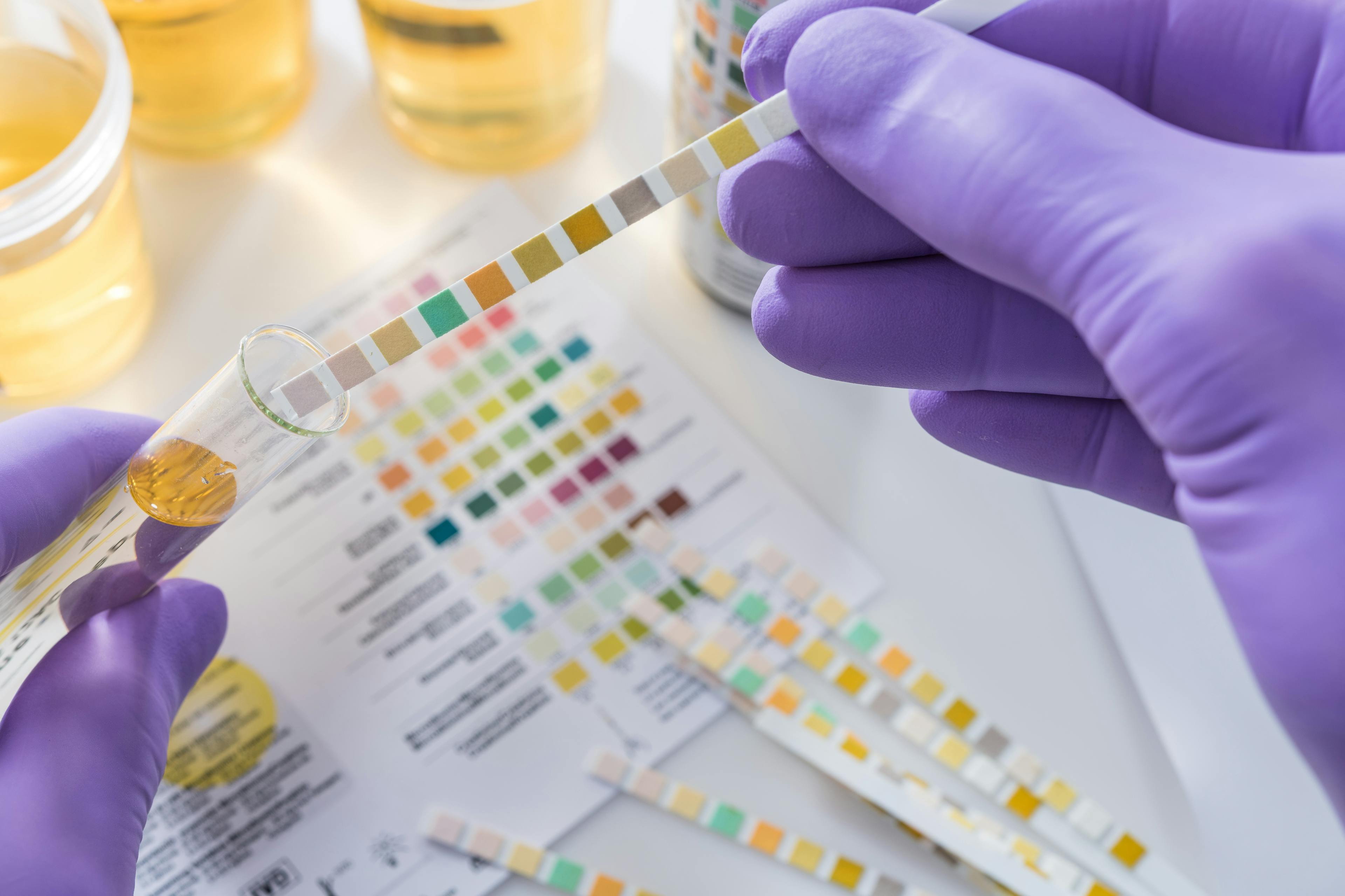 Urine test strips in purple gloves.