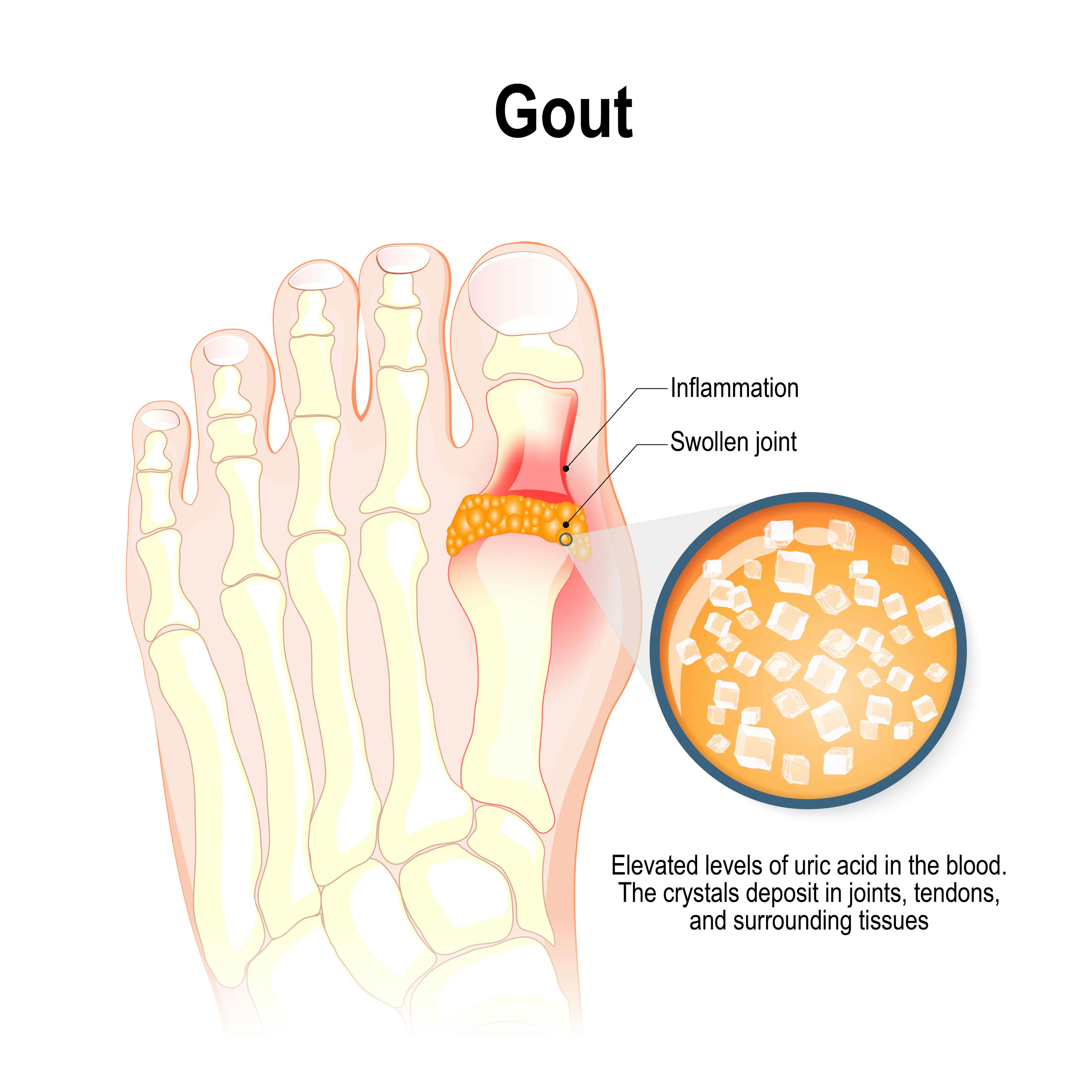 Illustration of Gout on a foot.