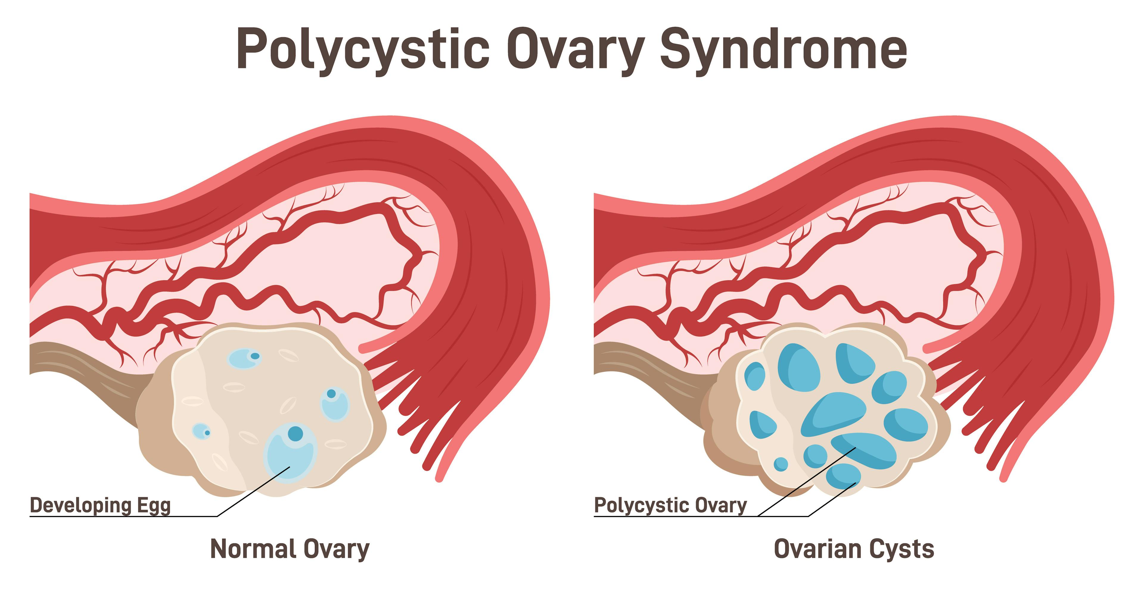 Illustration of normal ovary and polycystic ovary.